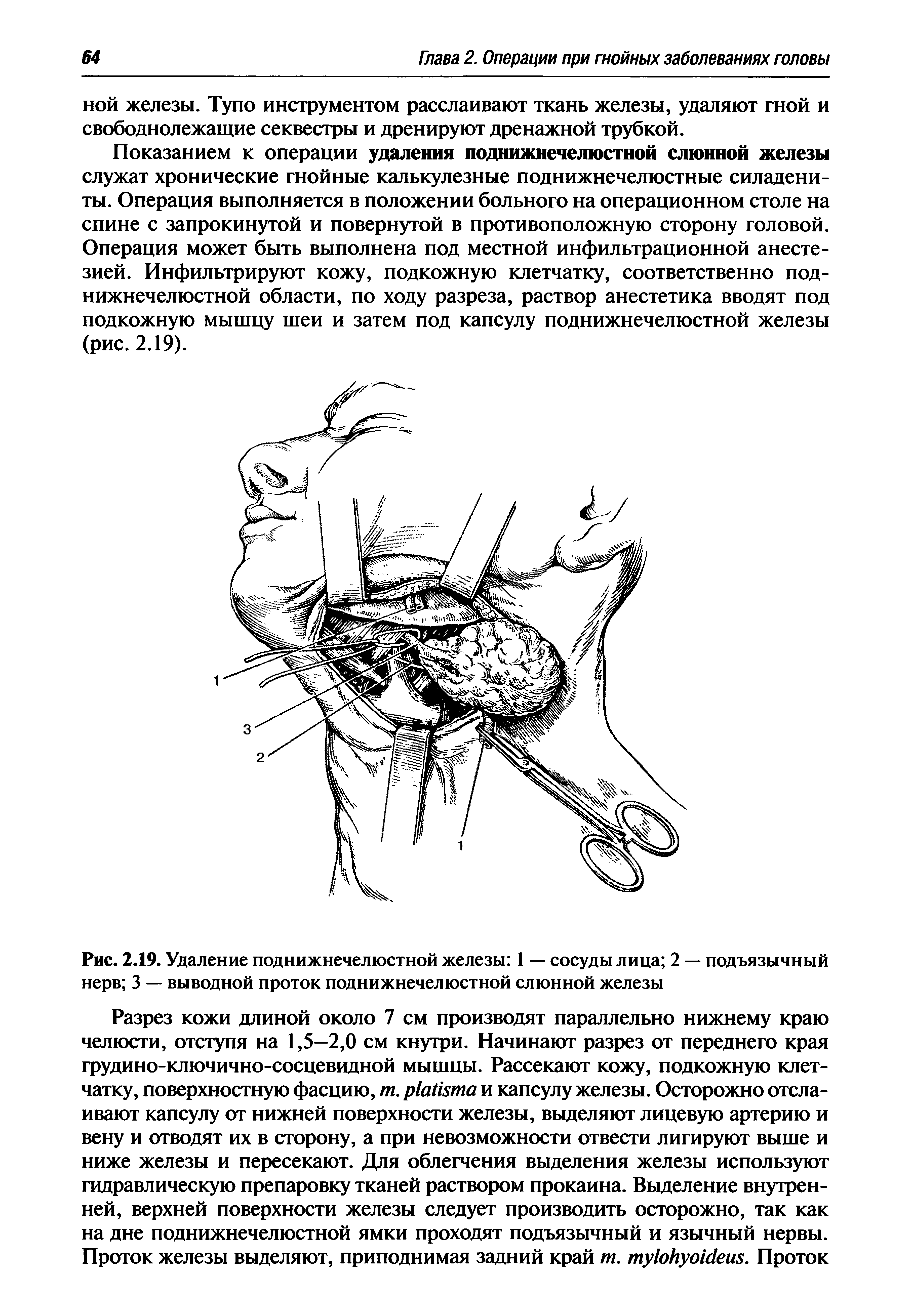 Рис. 2.19. Удаление поднижнечелюстной железы 1 — сосуды лица 2 — подъязычный нерв 3 — выводной проток поднижнечелюстной слюнной железы...
