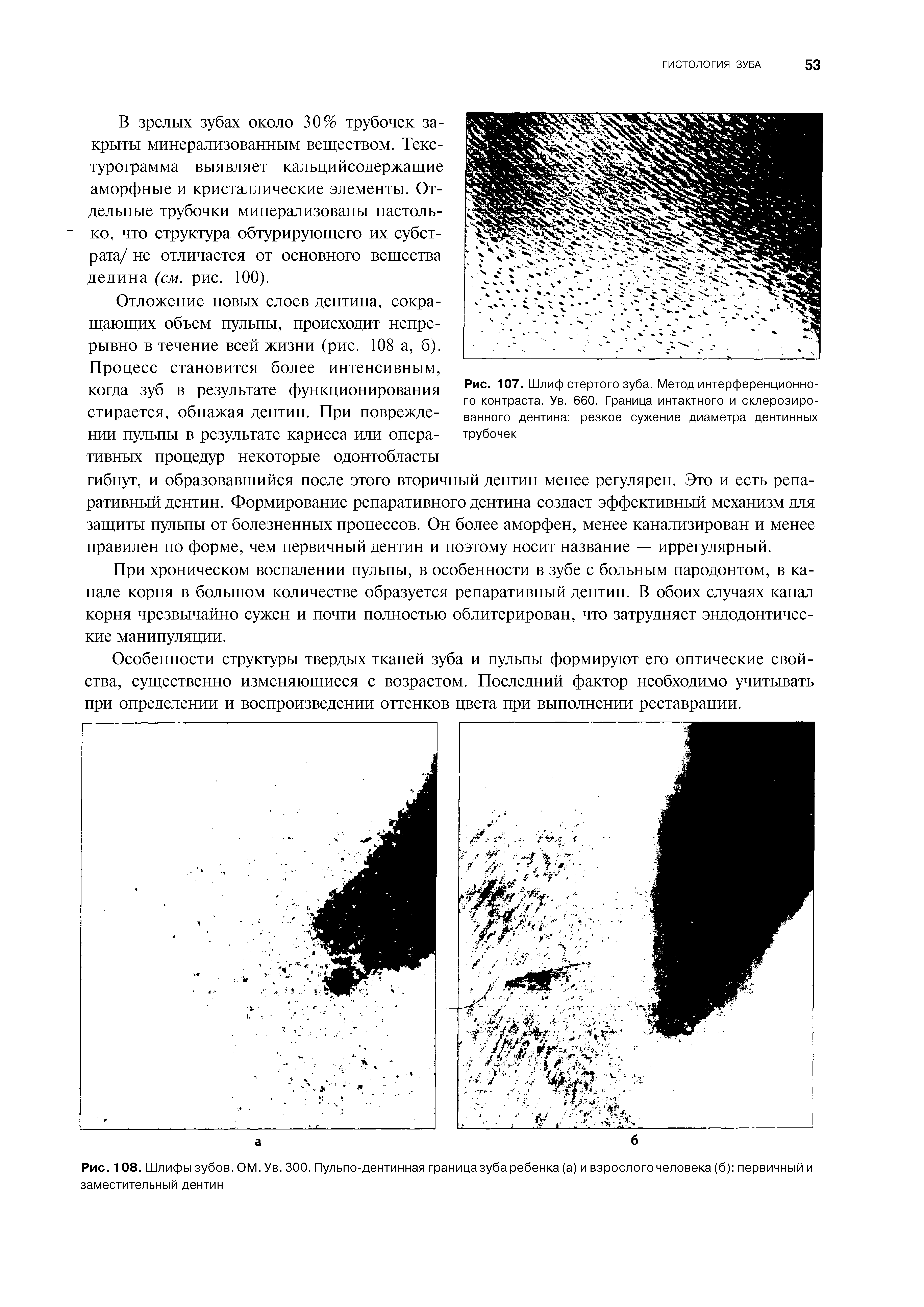Рис. 108. Шлифы зубов. ОМ.Ув. 300. Пульпо-дентинная границазуба ребенка (а) и взрослого человека (б) первичный и заместительный дентин...