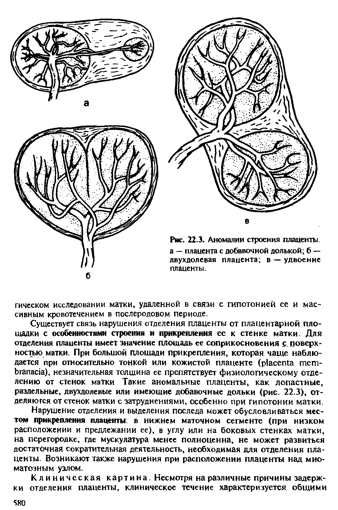 Рис. 22.3. Аномалии строения плаценты, а — плацента с добавочной долькой б — двухдолевая плацента в — удвоение плаценты.