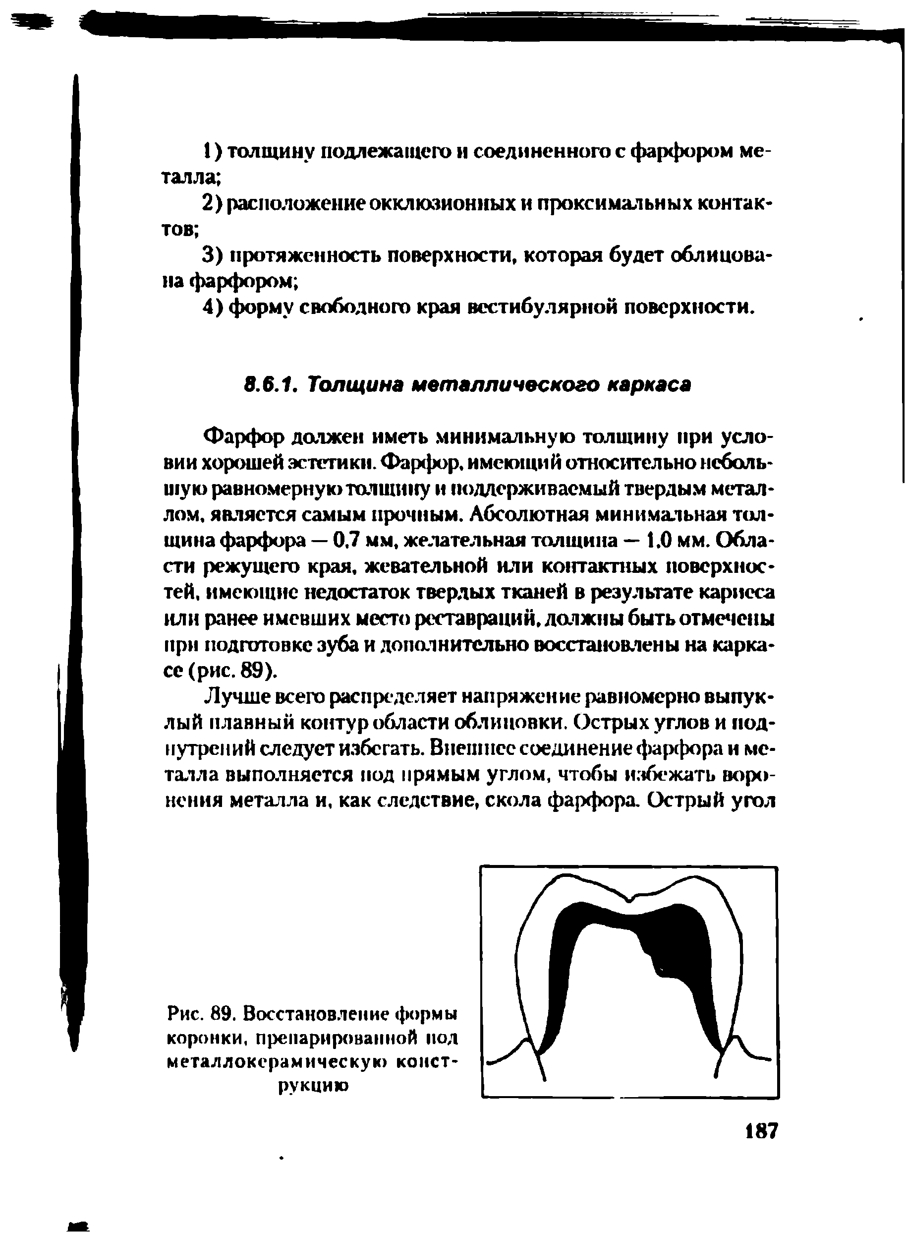 Рис. 89. Восстановление формы коронки, препарированной под металлокерамическую конструкцию...