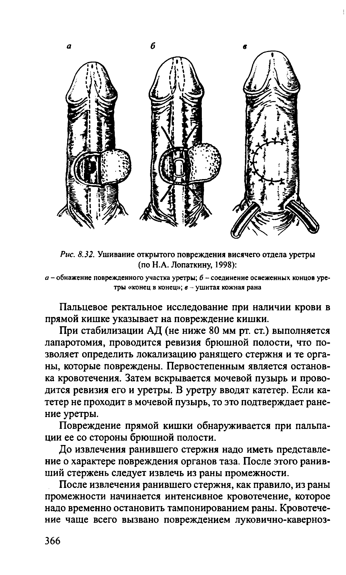 Рис. 8.32. Ушивание открытого повреждения висячего отдела уретры (по Н.А. Лопаткину, 1998) ...