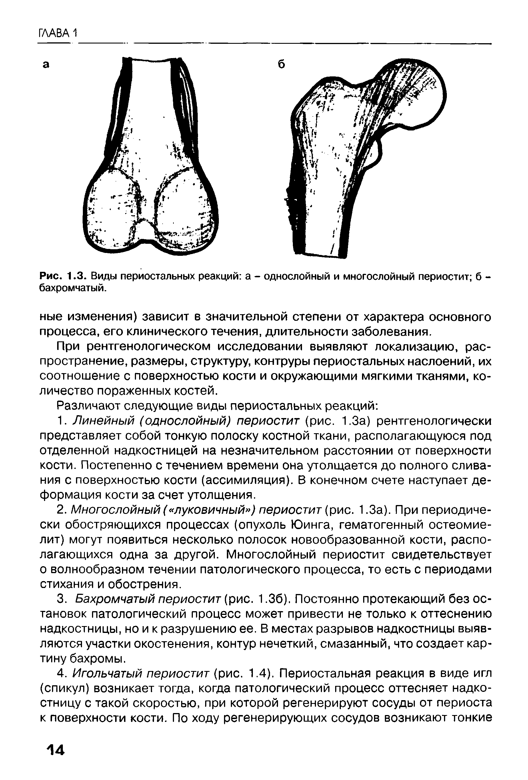 Рис. 1.3. Виды периостальных реакций а - однослойный и многослойный периостит б -бахромчатый.