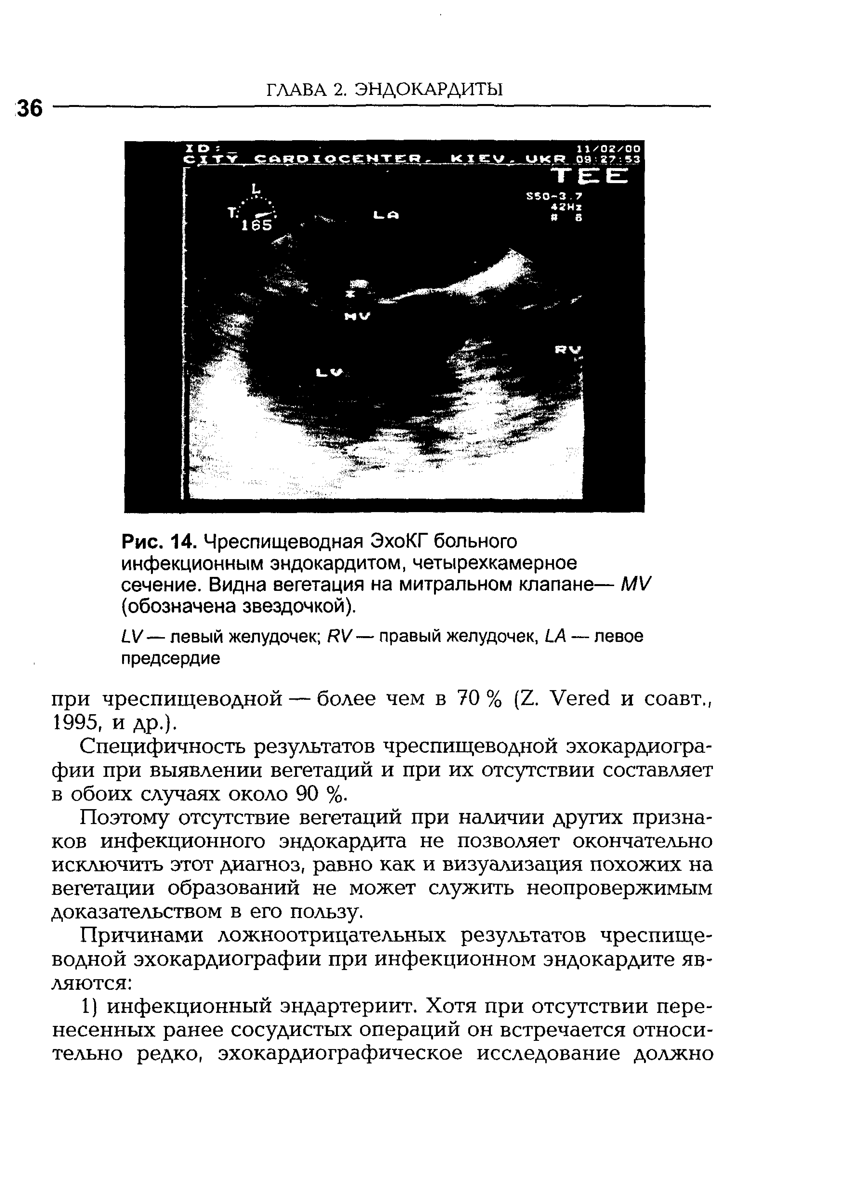 Рис. 14. Чреспищеводная ЭхоКГ больного инфекционным эндокардитом, четырехкамерное сечение. Видна вегетация на митральном клапане— МУ (обозначена звездочкой).