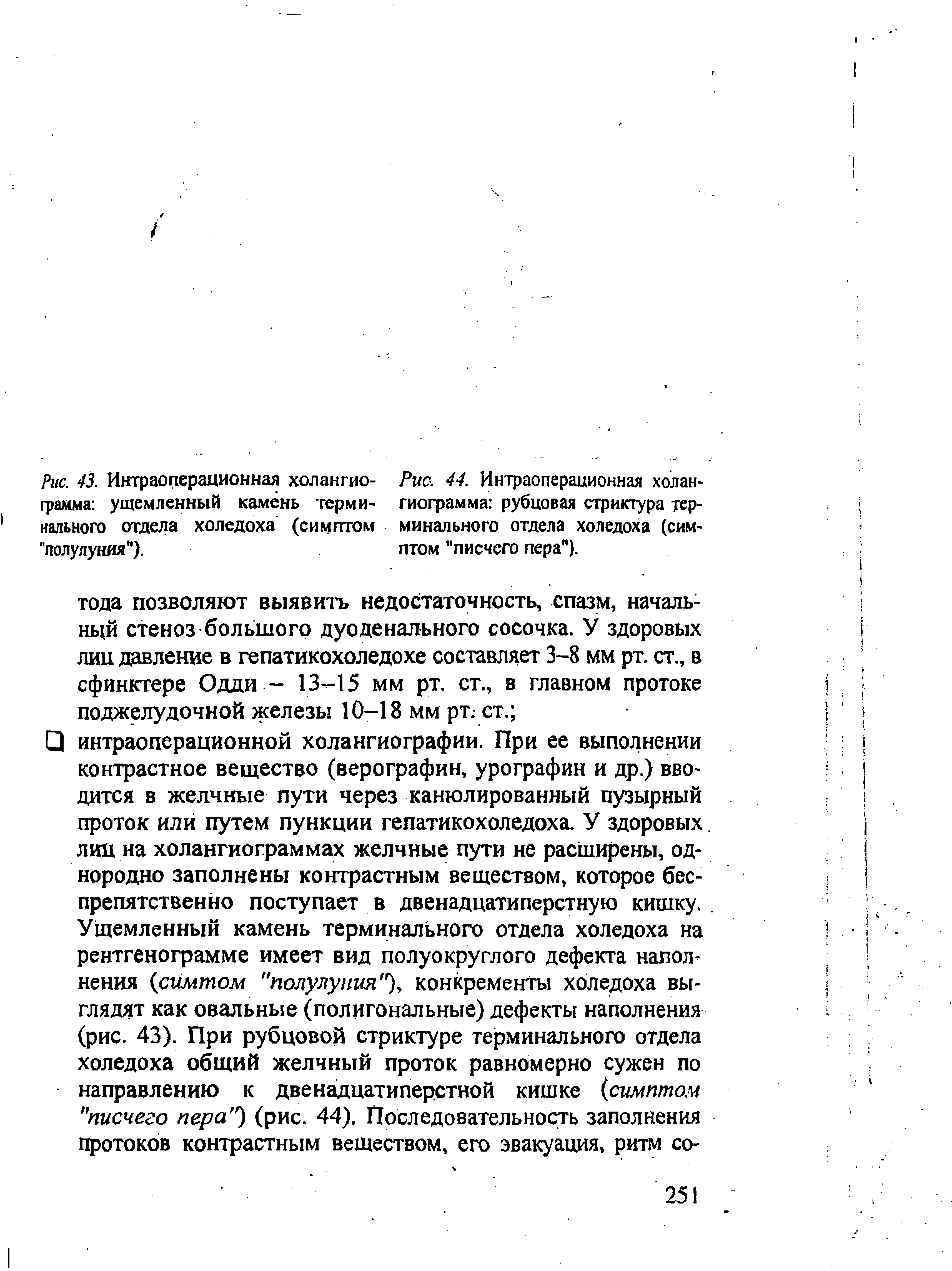 Рис. 44. Интраоперационная холан-гиограмма рубцовая стриктура терминального отдела холедоха (симптом "писчего пера").