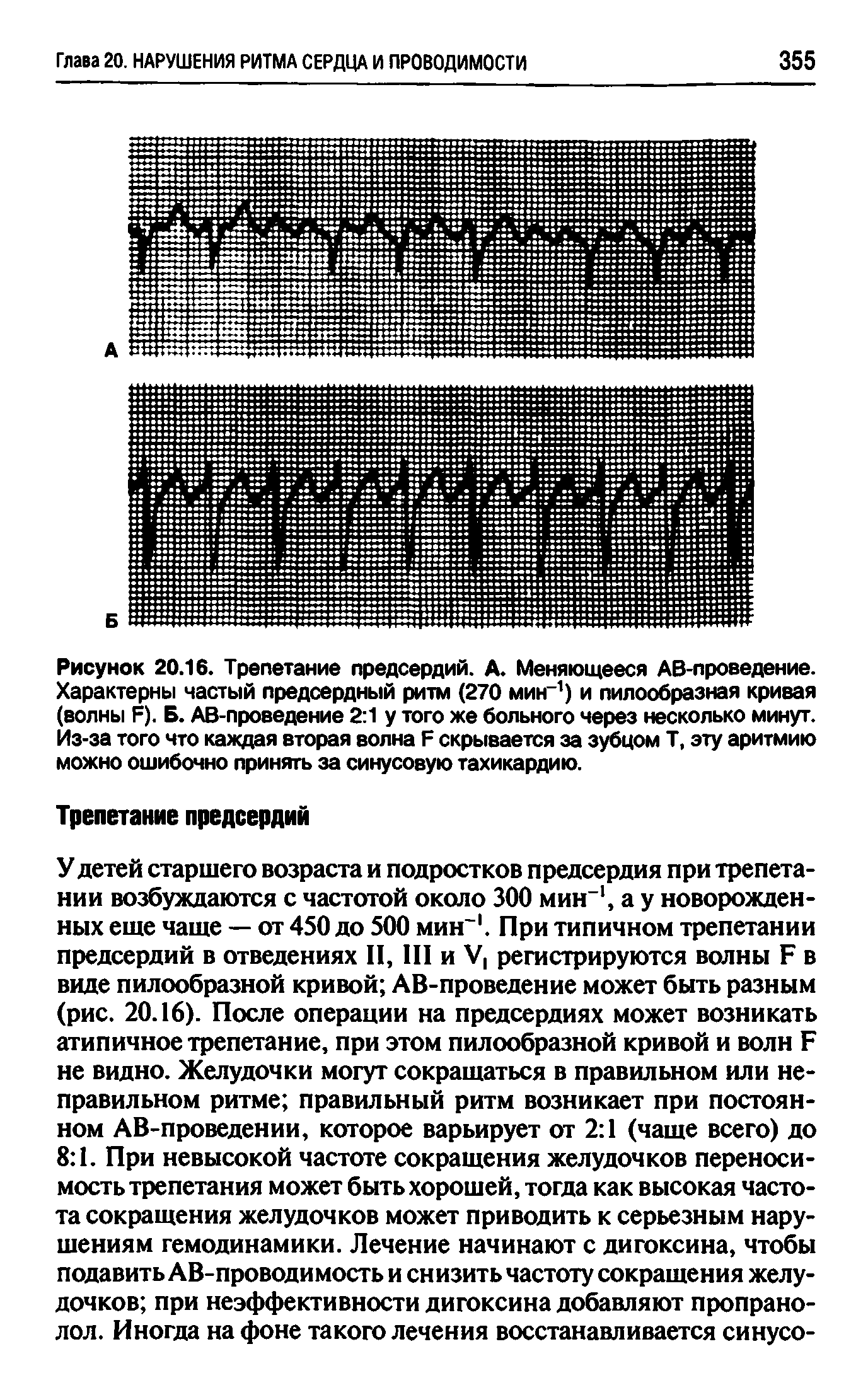 Рисунок 20.16. Трепетание предсердий. А. Меняющееся АВ-проведение. Характерны частый предсердный ритм (270 мин-1) и пилообразная кривая (волны Я). Б. АВ-проведение 2 1 у того же больного через несколько минут. Из-за того что каждая вторая волна Я скрывается за зубцом Т, эту аритмию можно ошибочно принять за синусовую тахикардию.