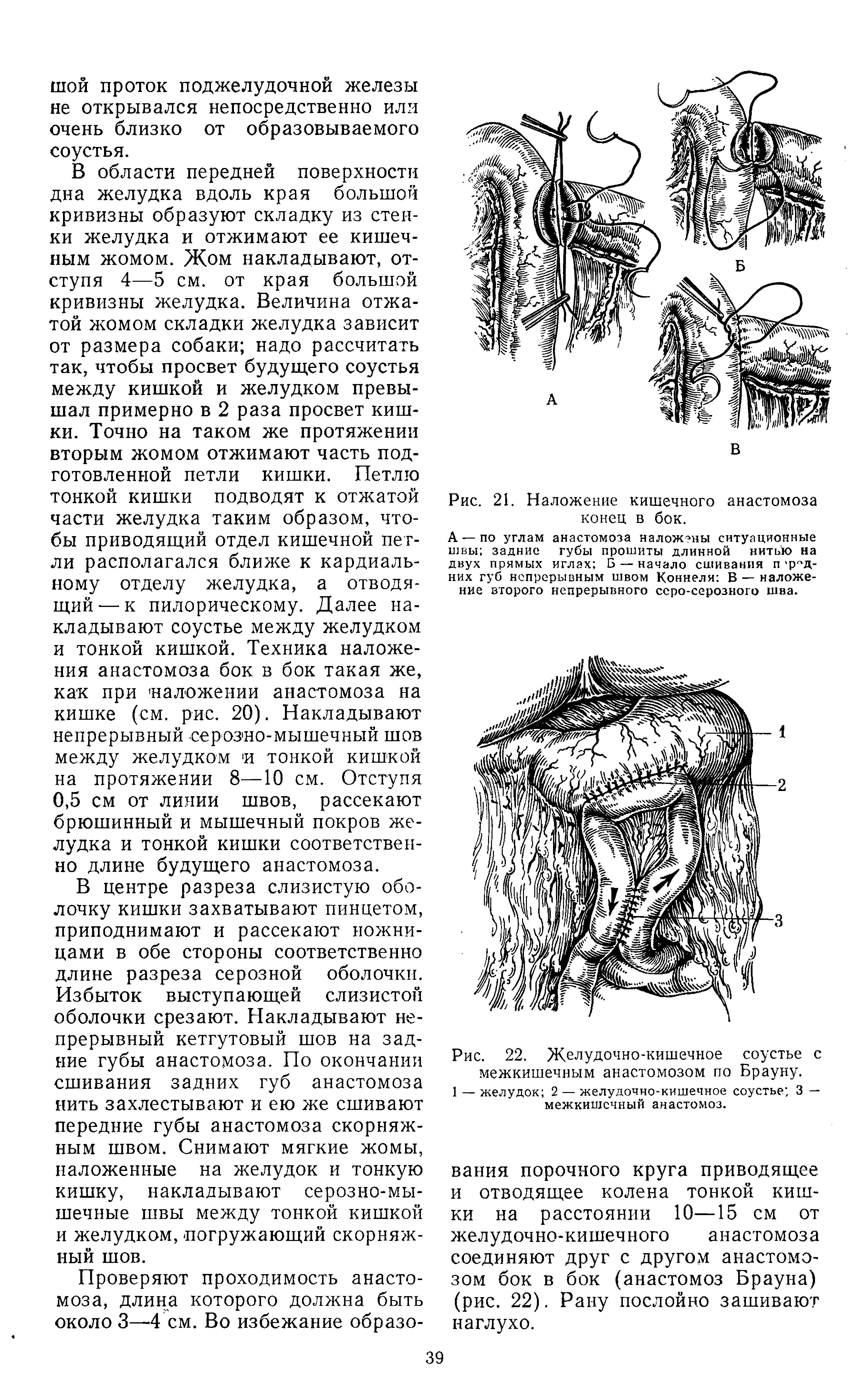 Рис. 22. Желудочно-кишечное соустье с межкишечным анастомозом по Брауну.