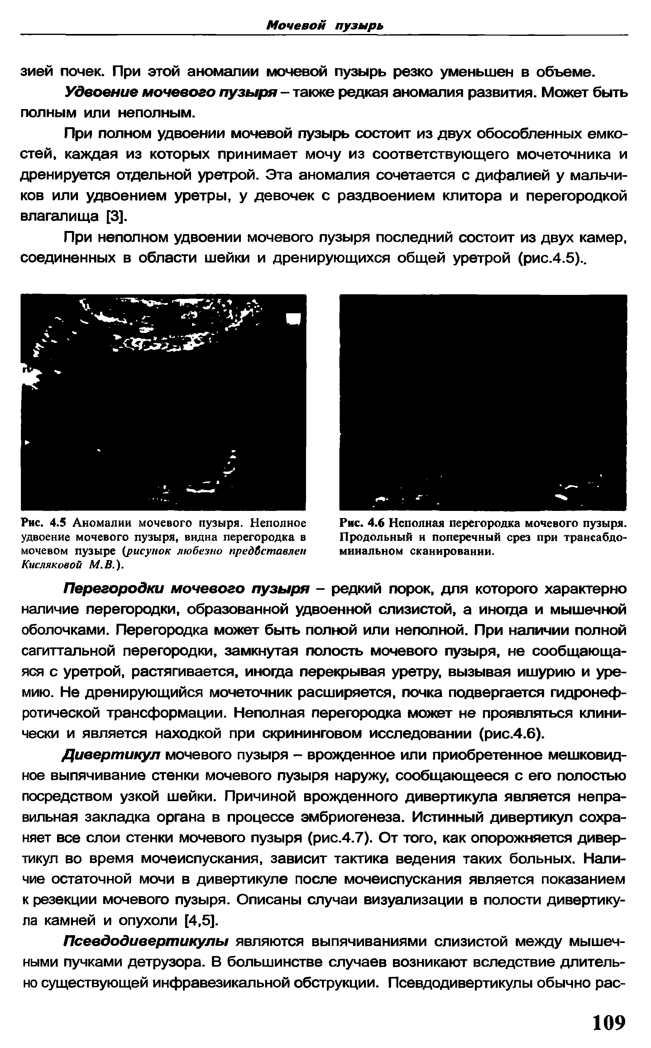 Рис. 4.5 Аномалии мочевого пузыря. Неполное удвоение мочевого пузыря, видна перегородка в мочевом пузыре (рисунок любезно предоставлен Кисляковой М.В.).