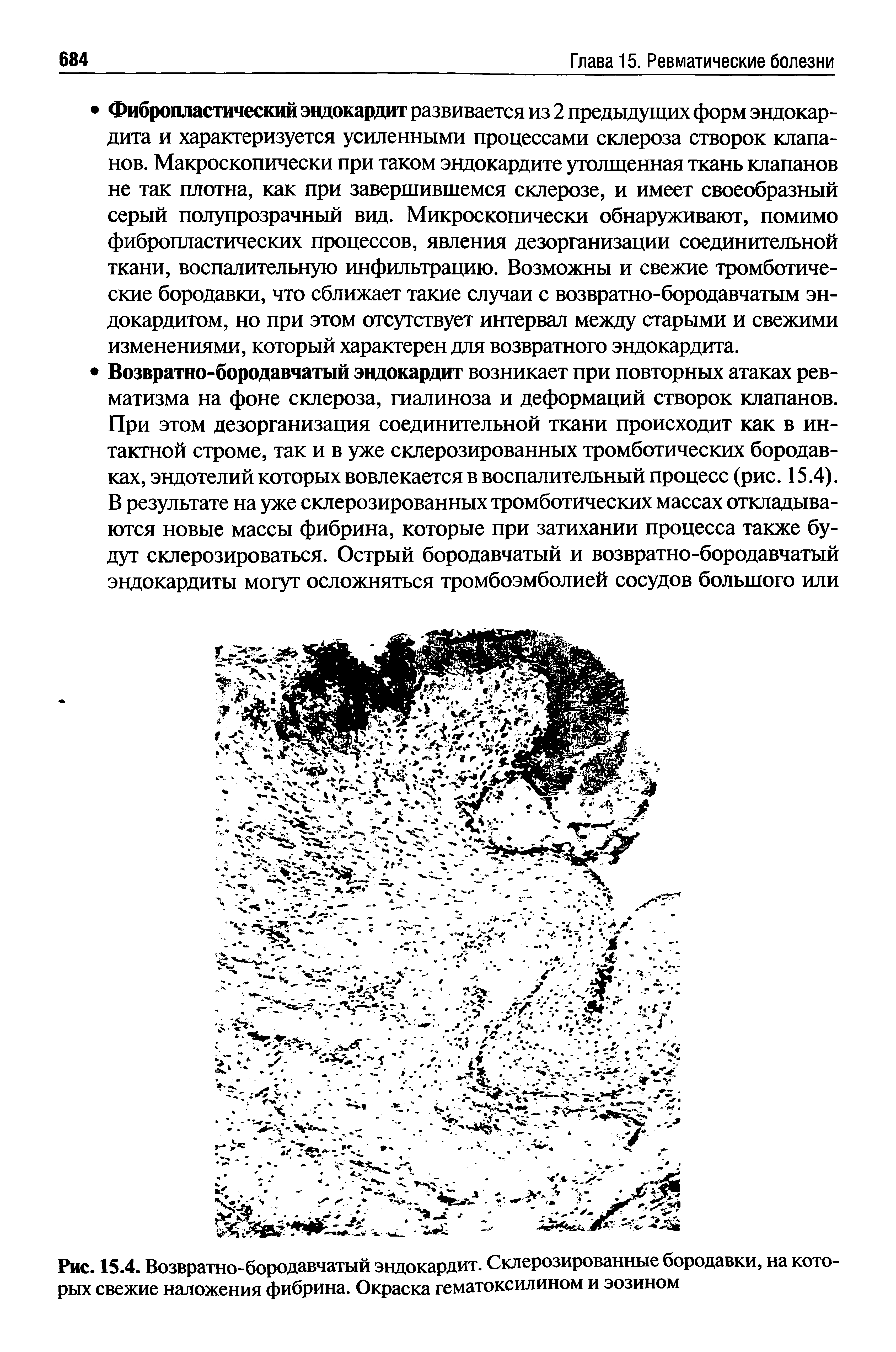 Рис. 15.4. Возвратно-бородавчатый эндокардит. Склерозированные бородавки, на которых свежие наложения фибрина. Окраска гематоксилином и эозином...