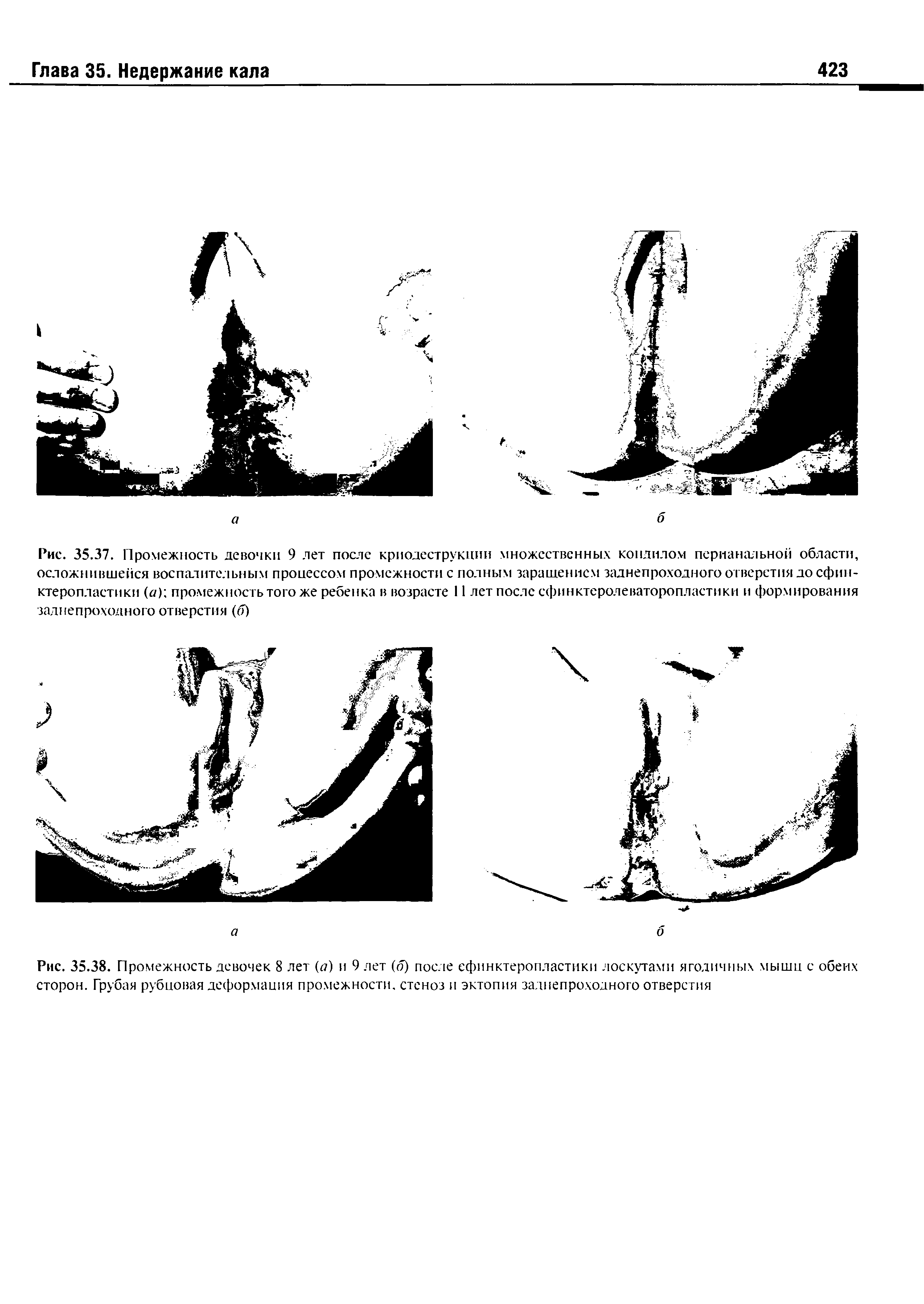 Рис. 35.38. Промежность девочек 8 лет (д) и 9 лет (б) после сфинктеропластики лоскутами ягодичных мышц с обеих сторон. Грубая рубцовая деформация промежности, стеноз и эктопия заднепроходного отверстия...