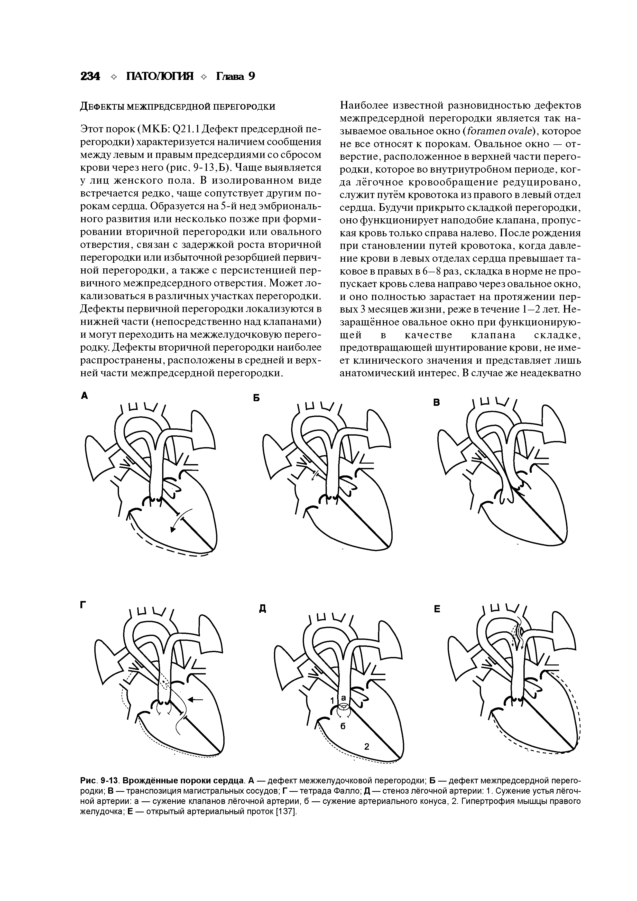 Рис. 9-13. Врождённые пороки сердца. А — дефект межжелудочковой перегородки Б — дефект межпредсердной перегородки В — транспозиция магистральных сосудов Г — тетрада Фалло Д — стеноз лёгочной артерии 1. Сужение устья лёгочной артерии а — сужение клапанов лёгочной артерии, б — сужение артериального конуса, 2. Гипертрофия мышцы правого желудочка Е — открытый артериальный проток [137].