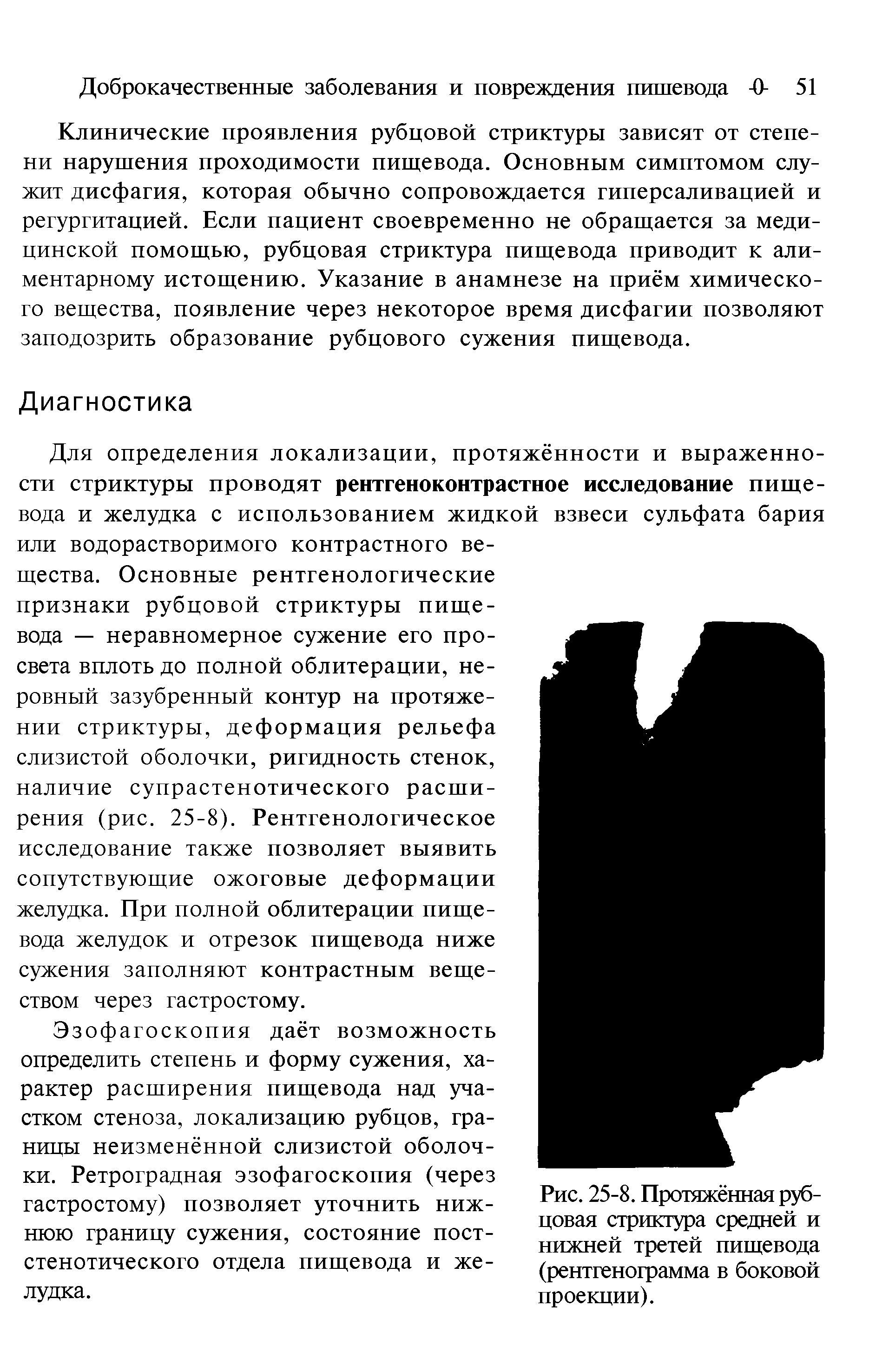 Рис. 25-8. Протяжённая рубцовая стриктура средней и нижней третей пищевода (рентгенограмма в боковой проекции).