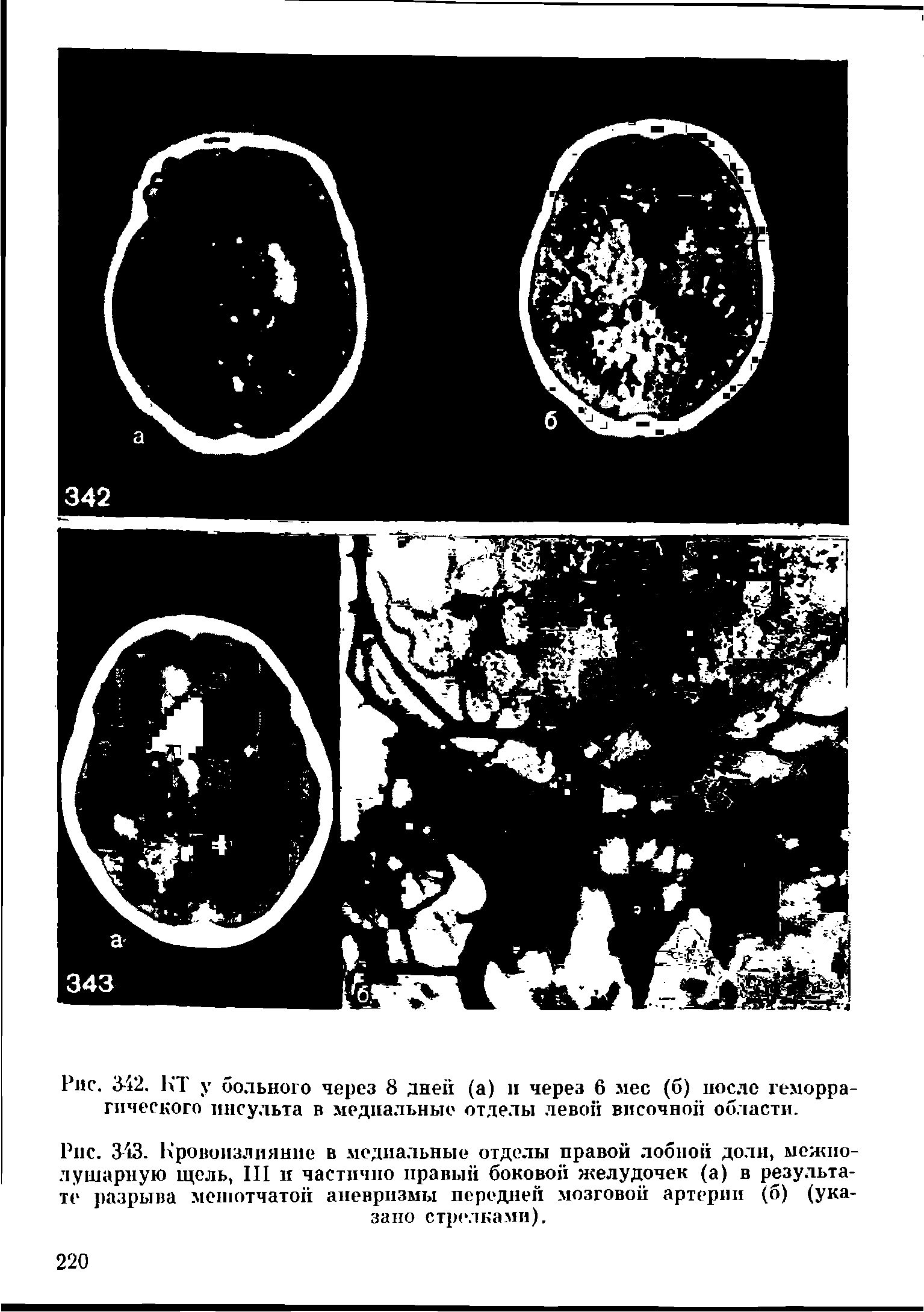 Рис. 343. Кровоизлияние в медиальные отделы правой лобной доли, межполушарную гцель, III и частично правый боковой желудочек (а) в результате разрыва мешотчатой аневризмы передней мозговой артерии (о) (указано стрелками).