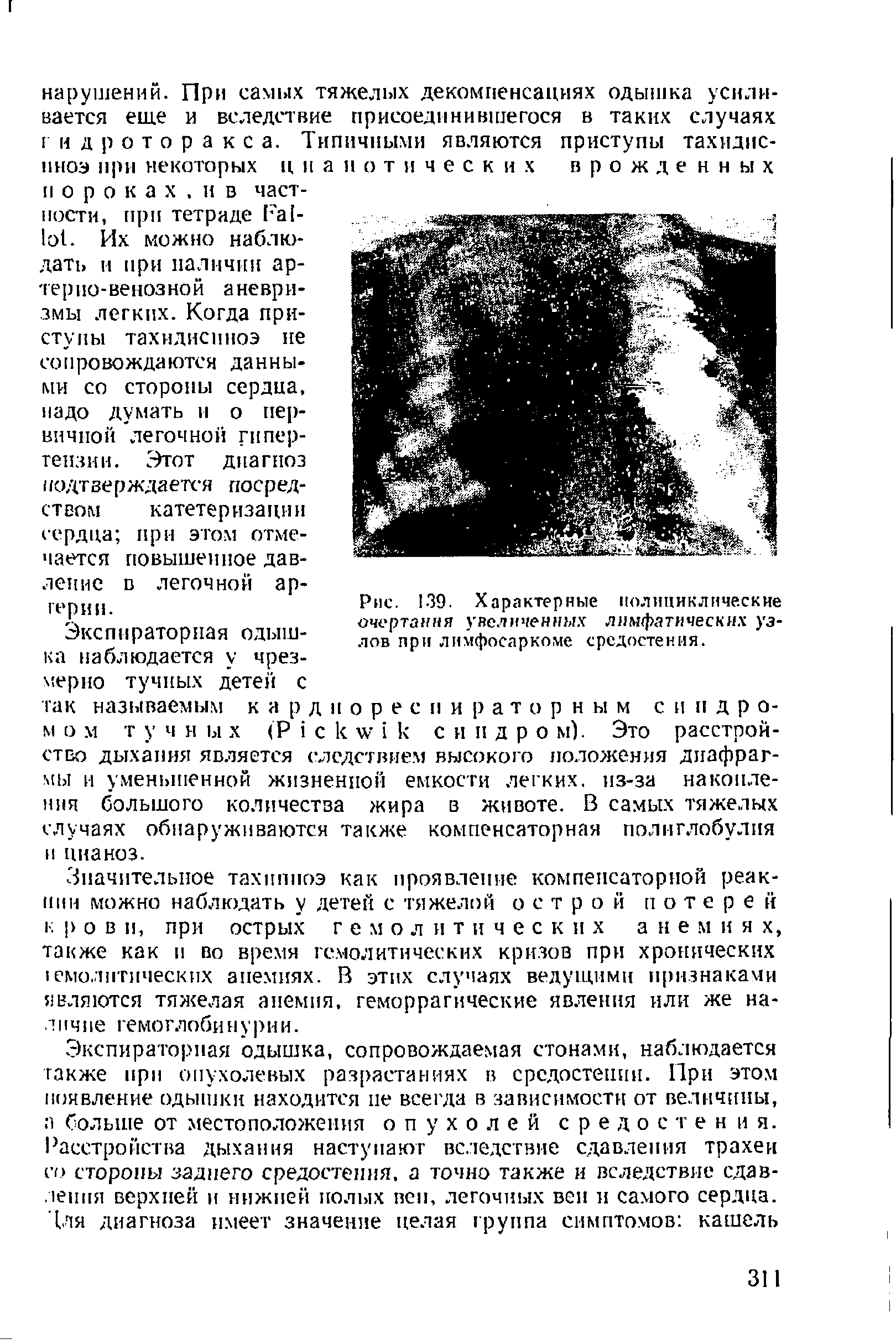 Рис. 139. Характерные полициклические очертания увеличенных лимфатических узлов при лимфосаркоме средостения.