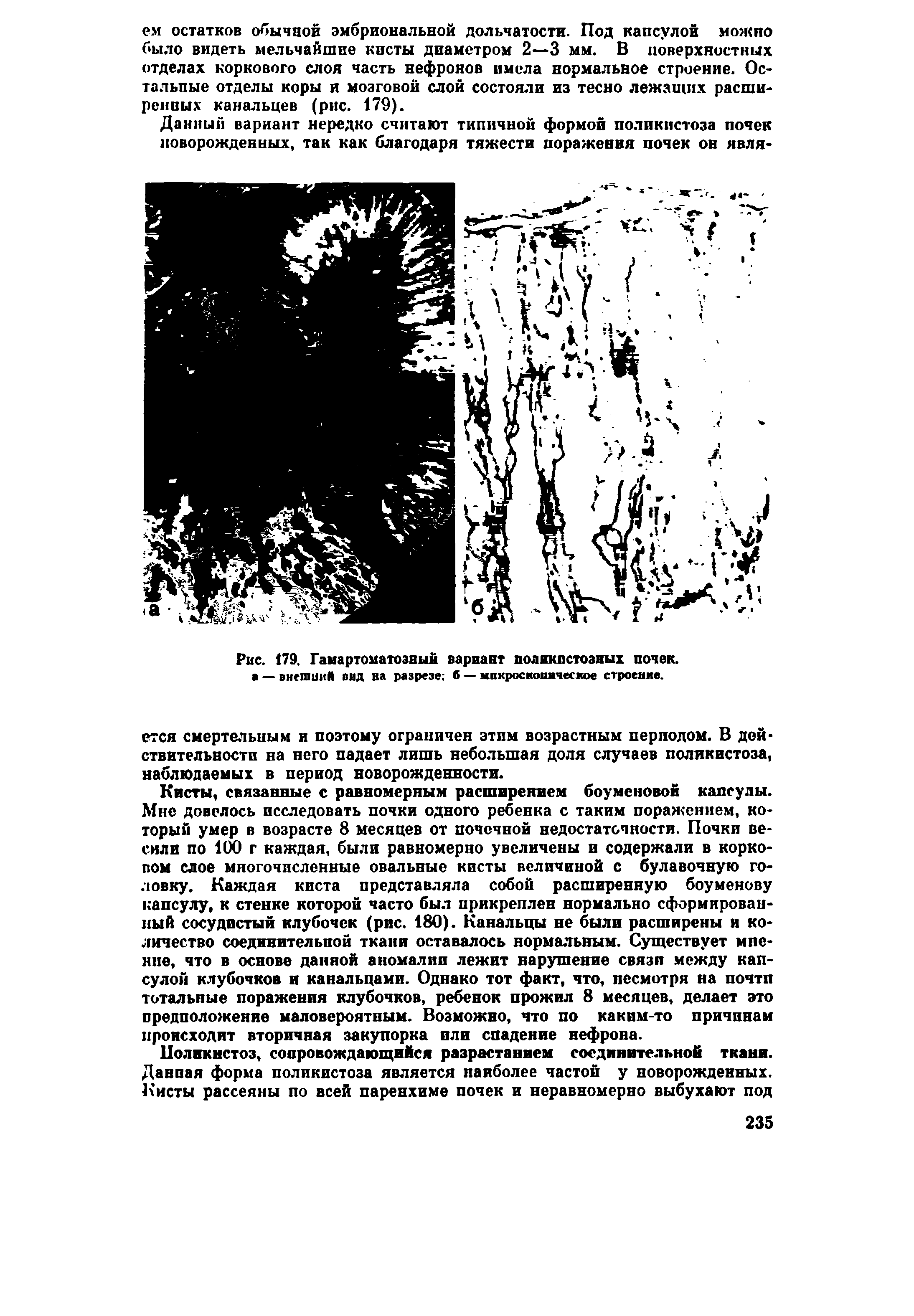 Рис. 179. Гамартоматозный вариант поликистозных почек, а — внешиий вид ва разрезе б — микроскопическое строение.