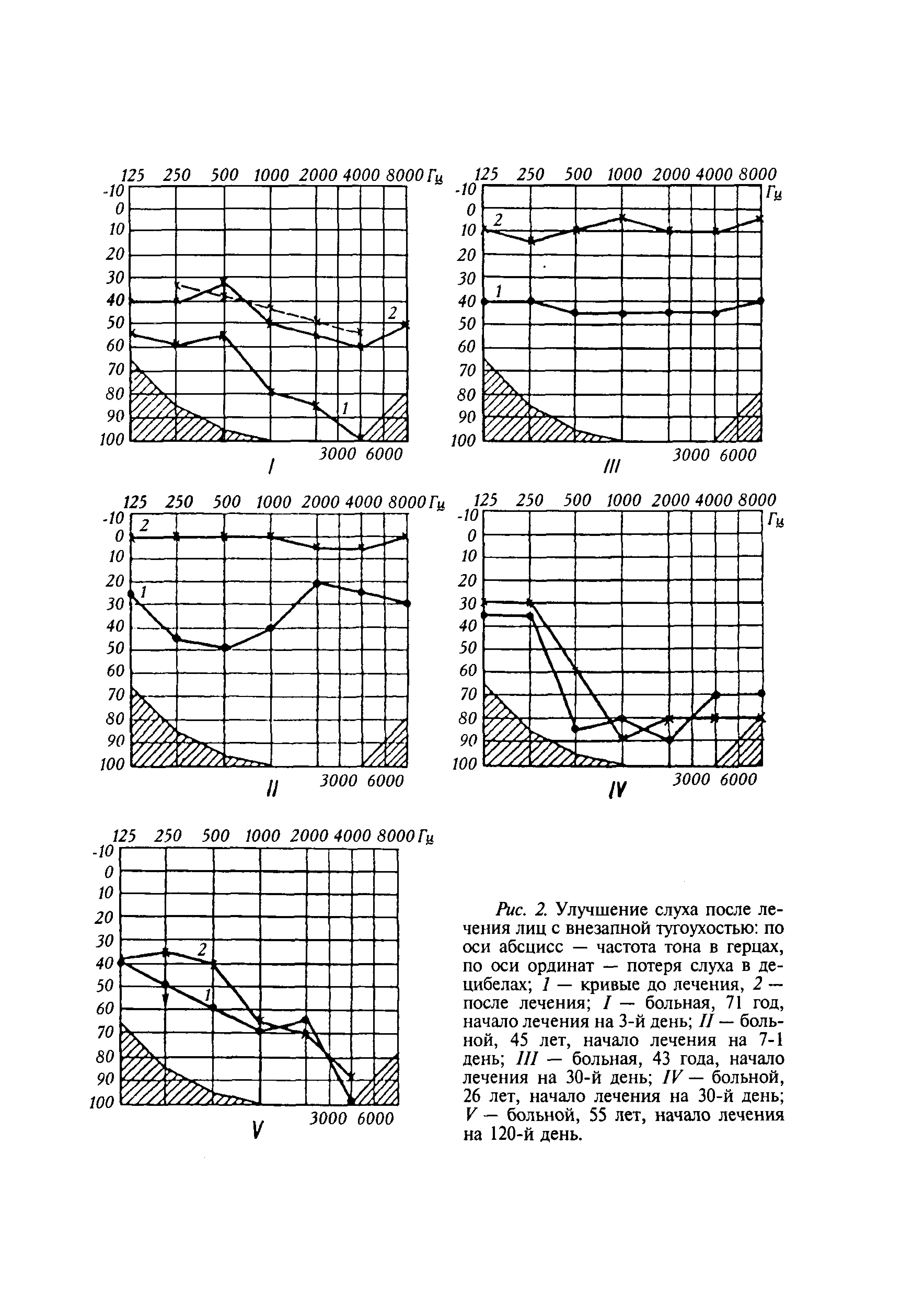 Рис. 2. Улучшение слуха после лечения лиц с внезапной тугоухостью по оси абсцисс — частота тона в герцах, по оси ординат — потеря слуха в децибелах 1 — кривые до лечения, 2 — после лечения I — больная, 71 год, начало лечения на 3-й день II — больной, 45 лет, начало лечения на 7-1 день III — больная, 43 года, начало лечения на 30-й день IV — больной, 26 лет, начало лечения на 30-й день V — больной, 55 лет, начало лечения на 120-й день.