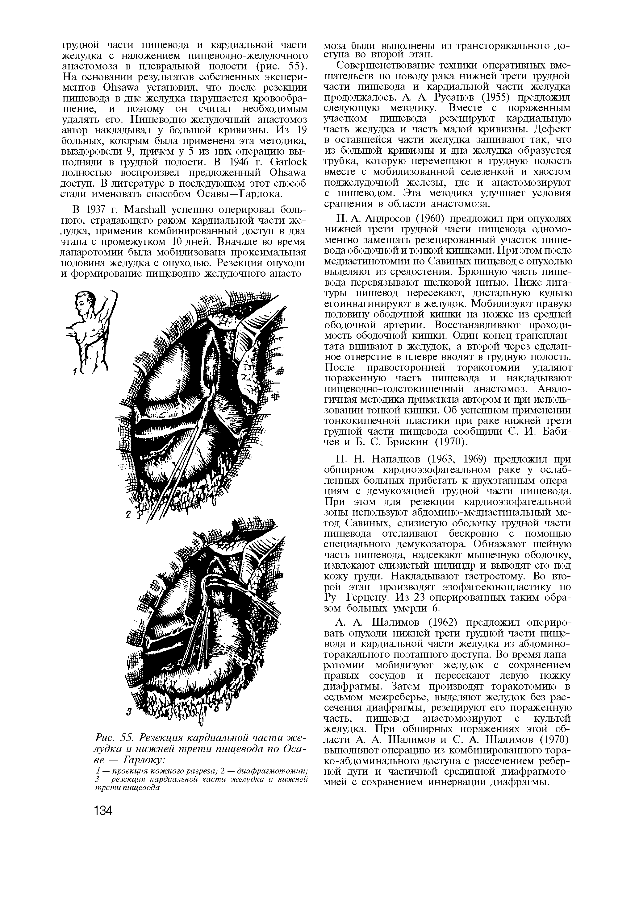 Рис. 55. Резекция кардиальной части желудка и нижней трети пищевода по Оса-ве — Гарлоку ...