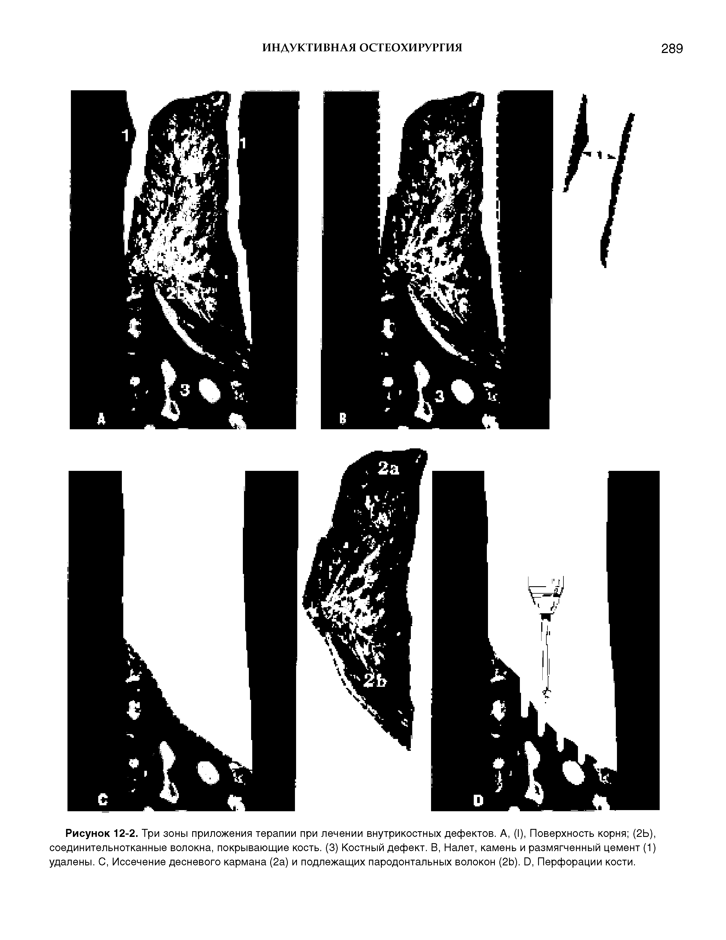 Рисунок 12-2. Три зоны приложения терапии при лечении внутрикостных дефектов. А, (I), Поверхность корня (2Ь), соединительнотканные волокна, покрывающие кость. (3) Костный дефект. В, Налет, камень и размягченный цемент (1) удалены. С, Иссечение десневого кармана (2а) и подлежащих пародонтальных волокон (2Ь). О, Перфорации кости.
