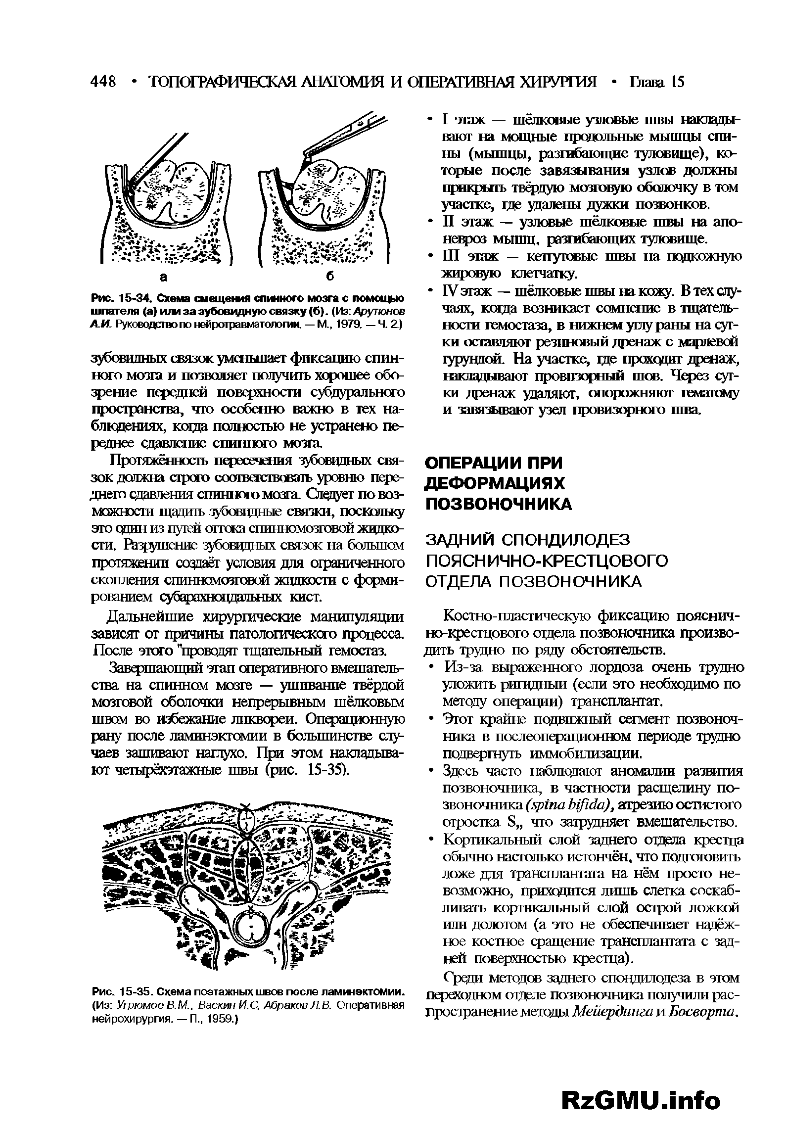 Рис. 15-34. Схема смещения спинного мозга с помощью шпателя (а) и/м за зубовидную связку (6). (Из Арутюнов ЛМ. Руководств по нейротравматолоши. — М.. 1979. — Ч. 2.)...