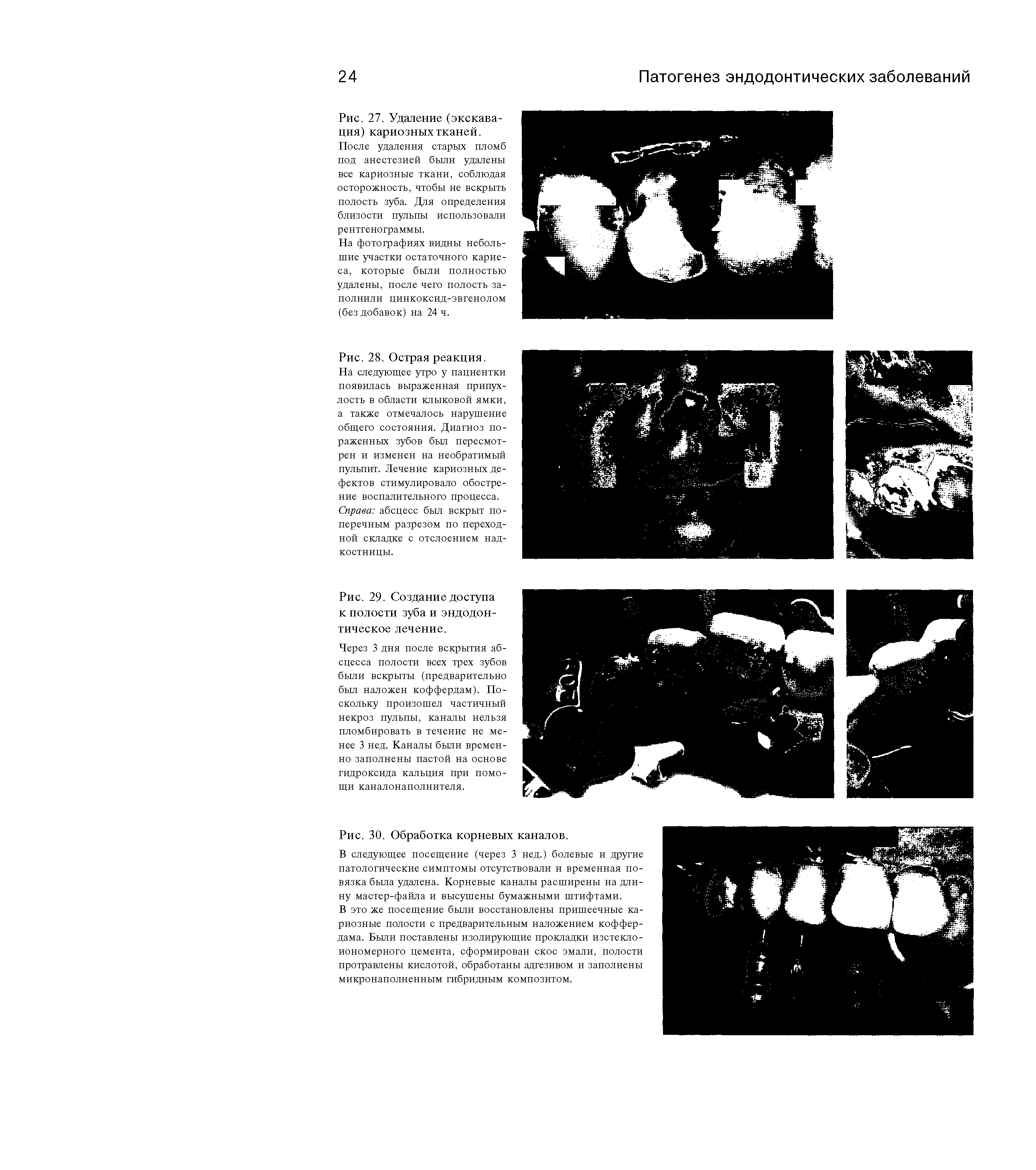 Рис. 29. Создание доступа к полости зуба и эндодонтическое лечение.