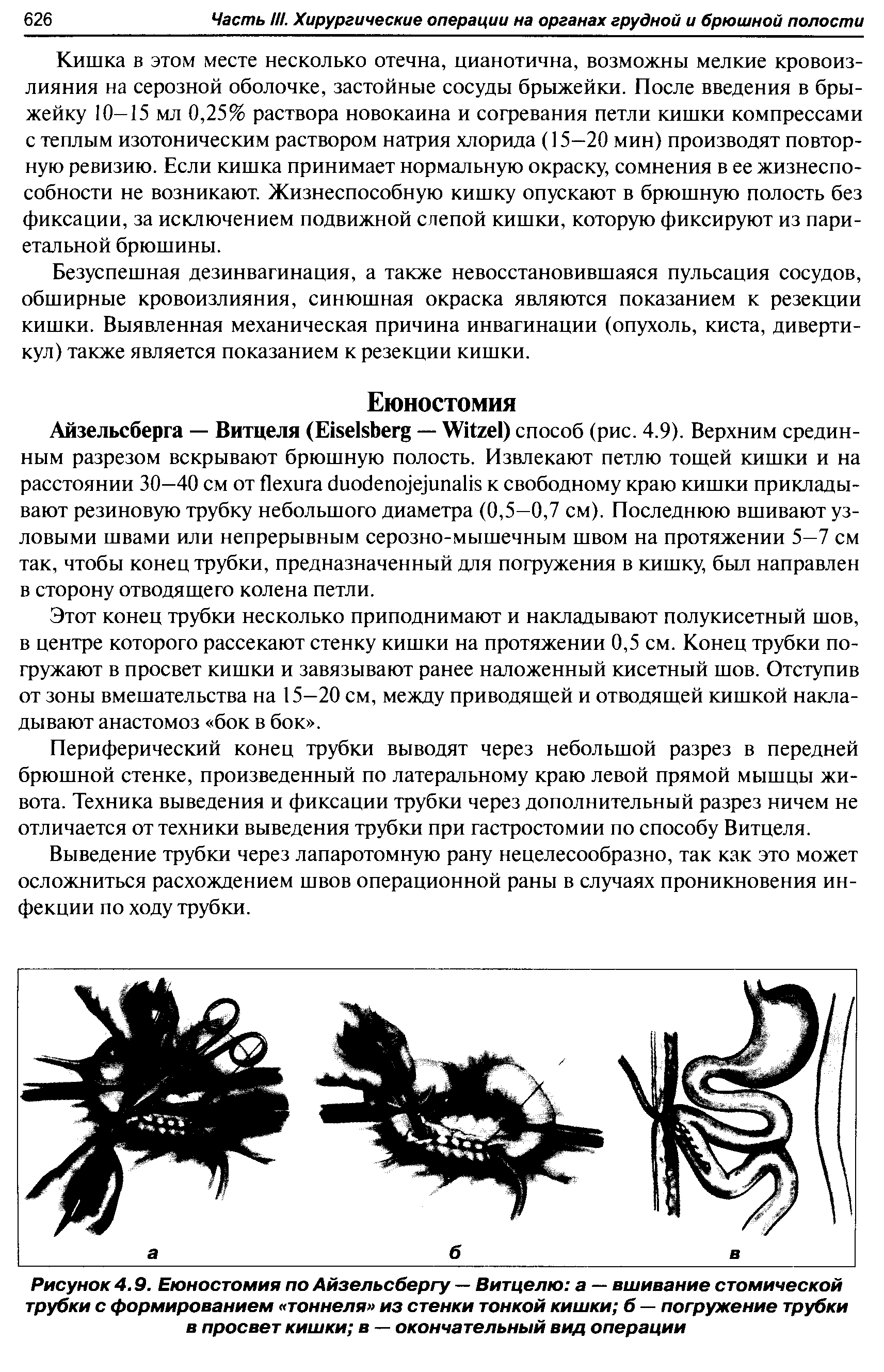 Рисунок 4.9. Еюностомия по Айзельсбергу — Витцелю а — вшивание стомической трубки с формированием тоннеля из стенки тонкой кишки б — погружение трубки в просвет кишки в — окончательный вид операции...