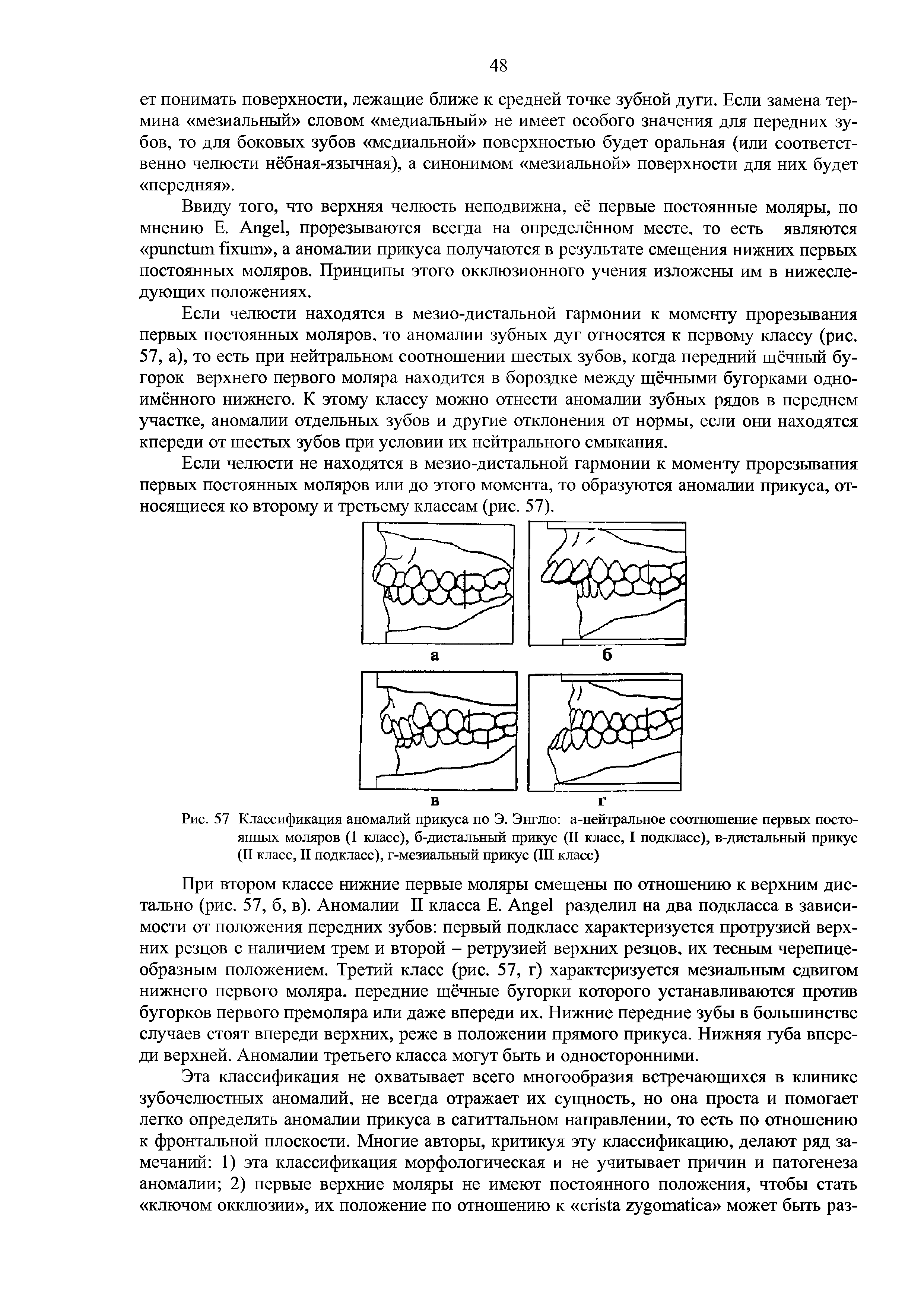 Рис. 57 Классификация аномалий прикуса по Э. Энглю а-нейтральное соотношение первых постоянных моляров (1 класс), б-дистальный прикус (II класс, I подкласс), в-дистальный прикус (II класс, II подкласс), г-мезиальный прикус (III класс)...