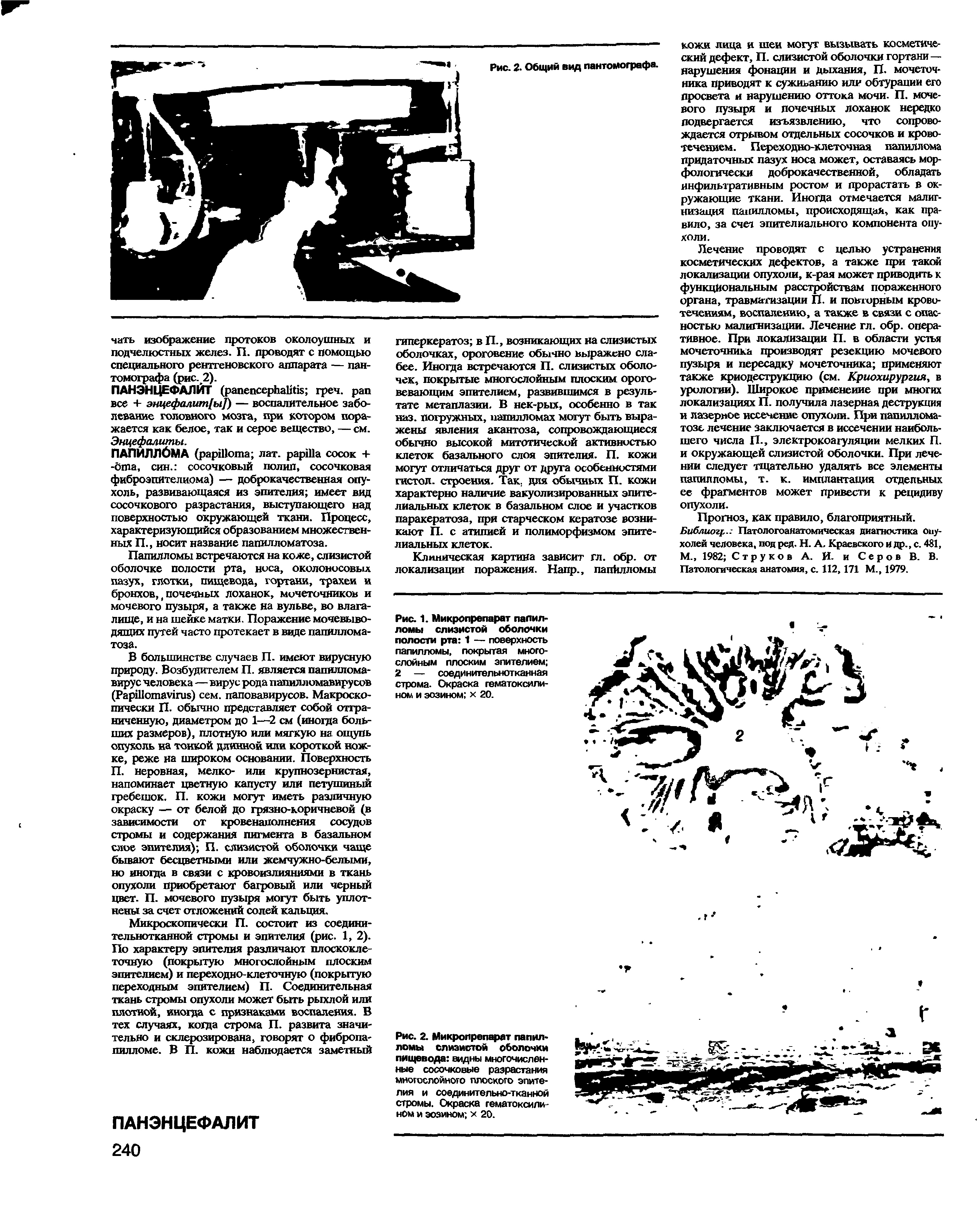 Рис. 2. Микропрепарат папилломы слизистой оболочки пищевода видны многочисленные сосочковые разрастания многослойного плоского эпителия и соединительно-тканной стромы. Окраска гематоксилином и эозином х 20.