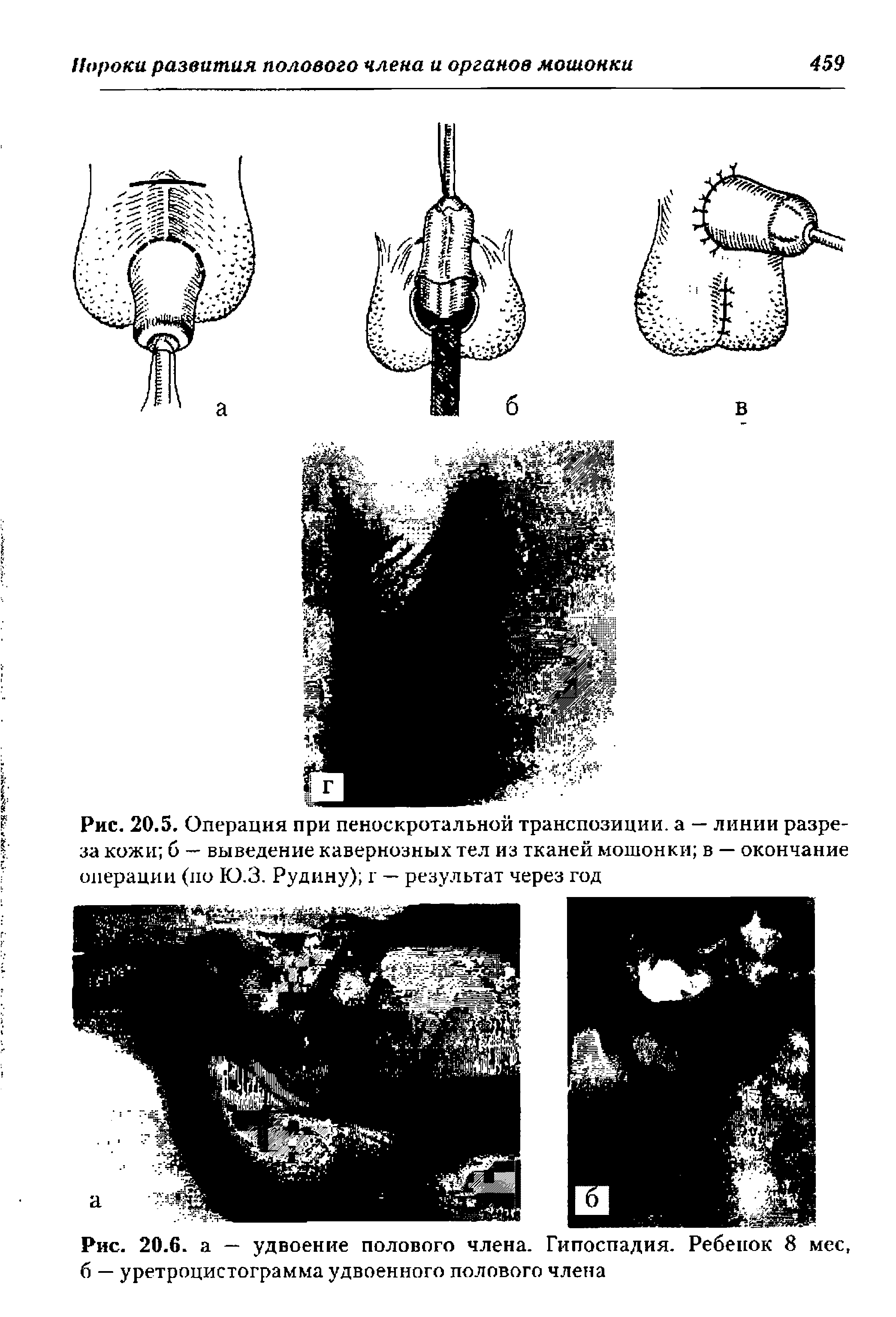 Рис. 20.5. Операция при пеноскротальной транспозиции, а — линии разреза кожи б — выведение кавернозных тел из тканей мошонки в — окончание операции (по Ю.З. Рудину) г — результат через год...