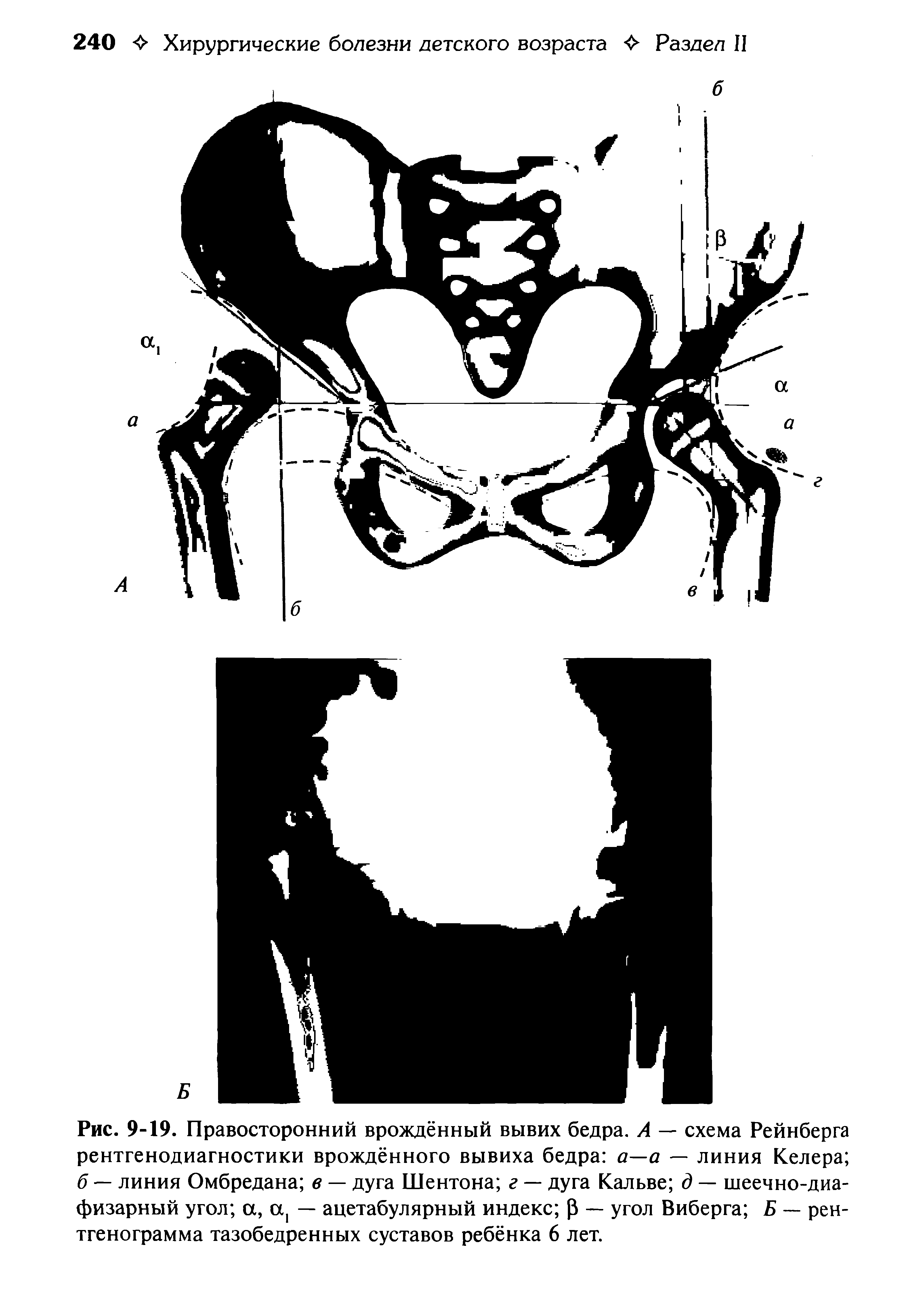 Рис. 9-19. Правосторонний врождённый вывих бедра. А — схема Рейнберга рентгенодиагностики врождённого вывиха бедра а—а — линия Келера б — линия Омбредана в — дуга Шентона г — дуга Кальве д — шеечно-диафизарный угол а, а1 — ацетабулярный индекс р — угол Виберга Б — рентгенограмма тазобедренных суставов ребёнка 6 лет.