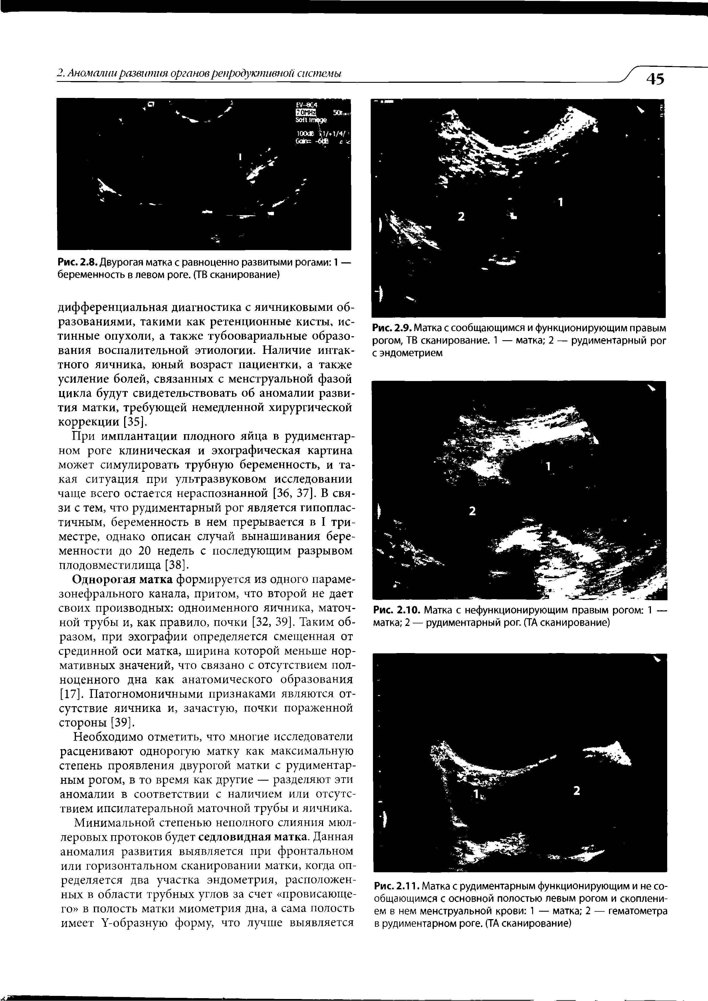 Рис. 2.11. Матка с рудиментарным функционирующим и не сообщающимся с основной полостью левым рогом и скоплением в нем менструальной крови 1 — матка 2 — гематометра в рудиментарном роге. (ТА сканирование)...