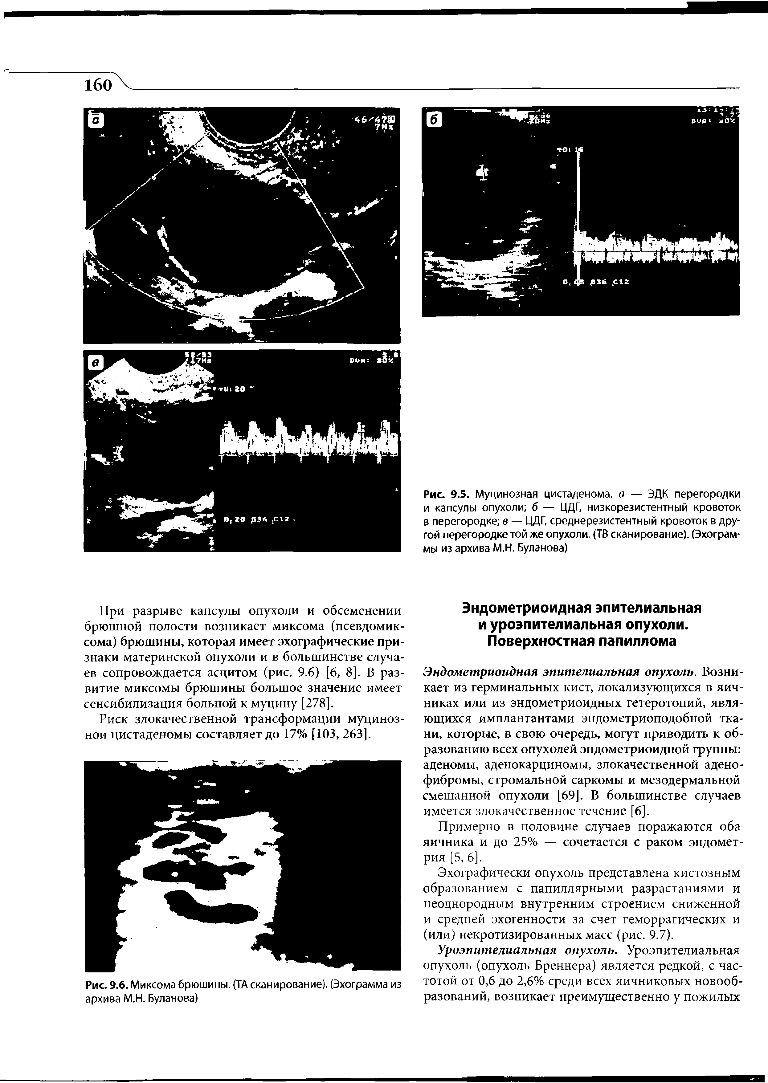 Рис. 9.5. Муцинозная цистаденома. а — ЭДК перегородки и капсулы опухоли б — ЦДГ, низкорезистентный кровоток в перегородке в — ЦДГ, среднерезистентный кровоток в другой перегородке той же опухоли. (ТВ сканирование). (Эхограммы из архива М.Н. Буланова)...