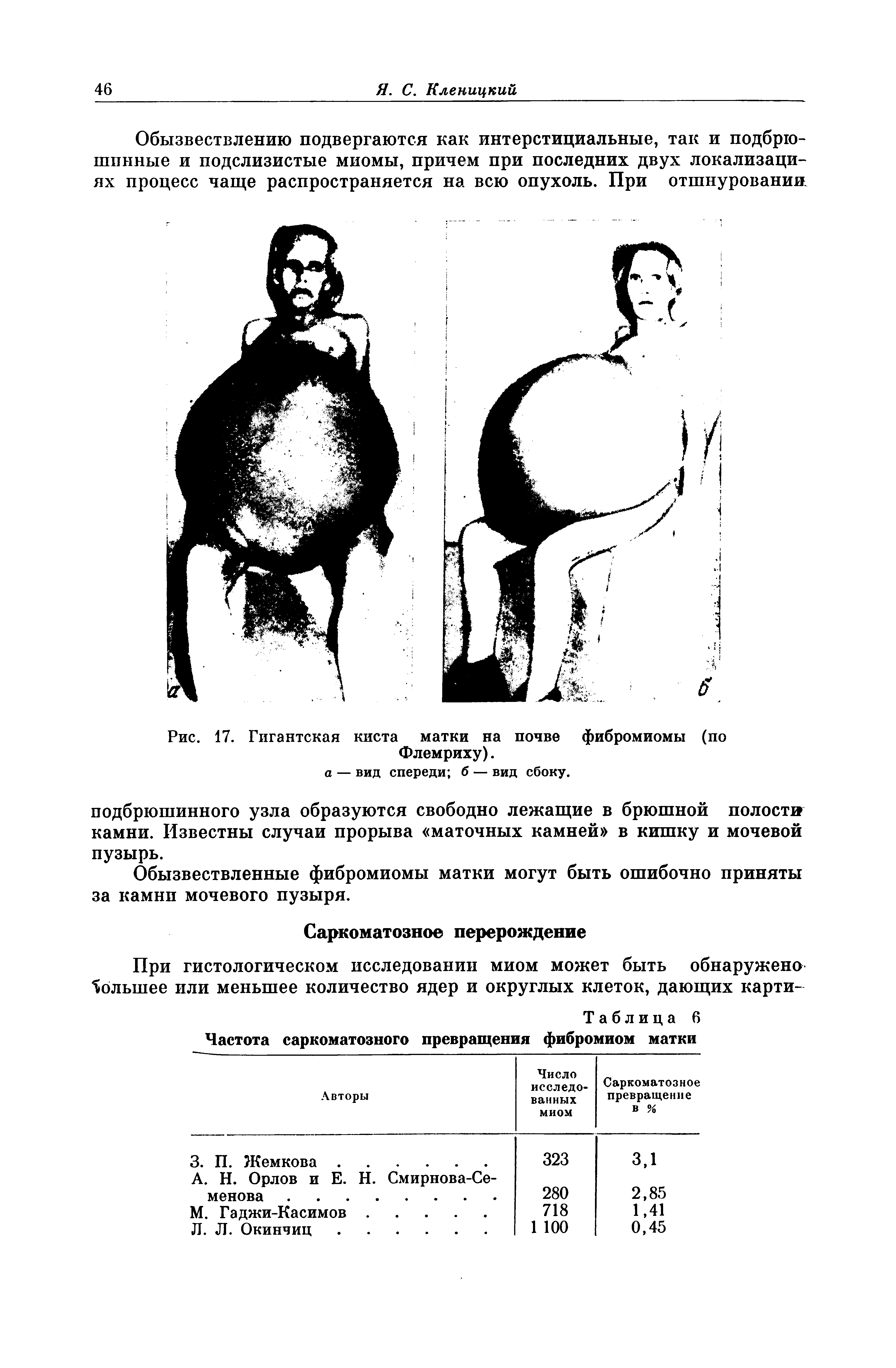 Рис. 17. Гигантская киста матки на почве фибромиомы (по Флемриху).