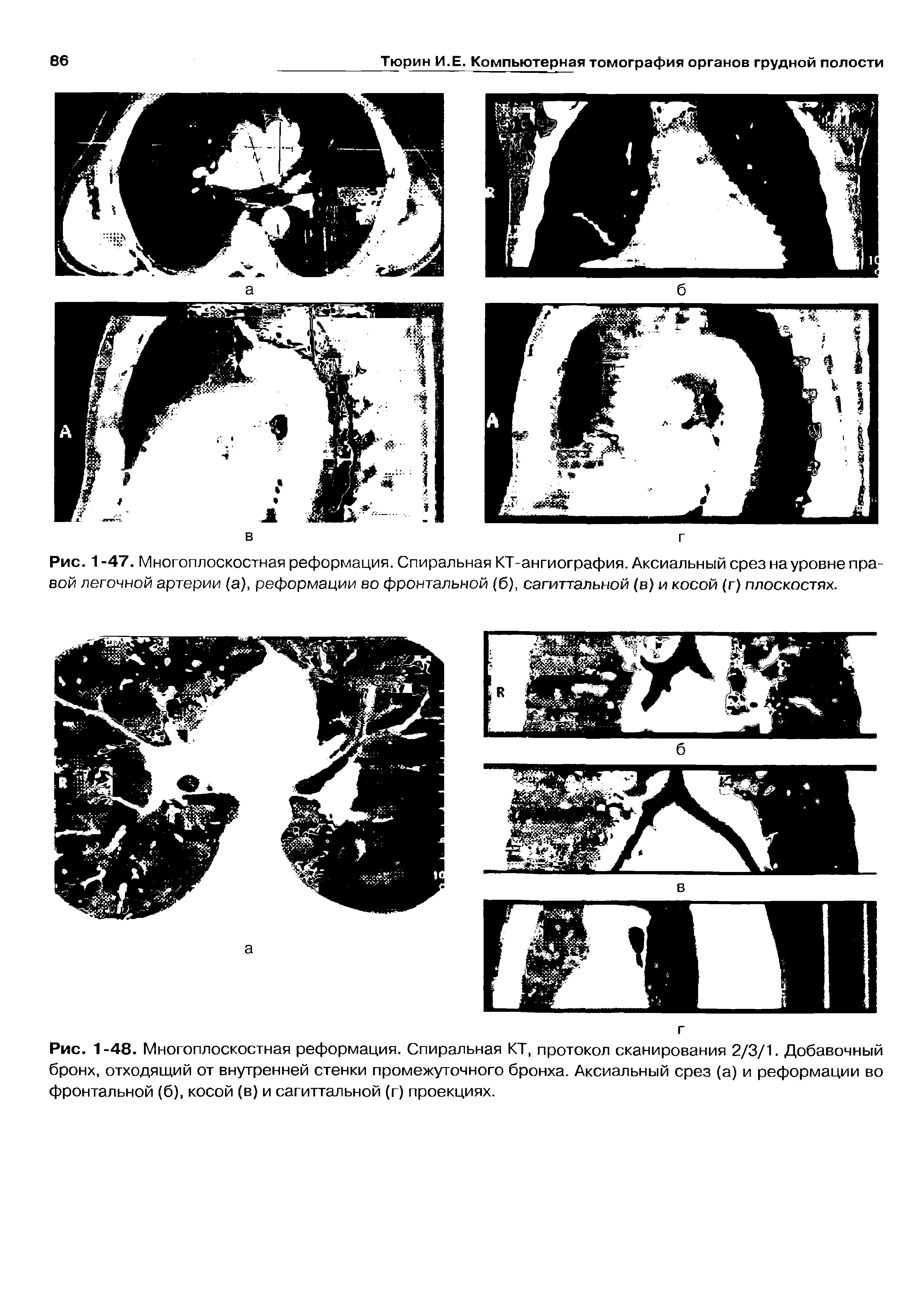 Рис. 1 -47. Многоплоскостная реформация. Спиральная КТ-ангиография. Аксиальный срез на уровне правой легочной артерии (а), реформации во фронтальной (б), сагиттальной (в) и косой (г) плоскостях.