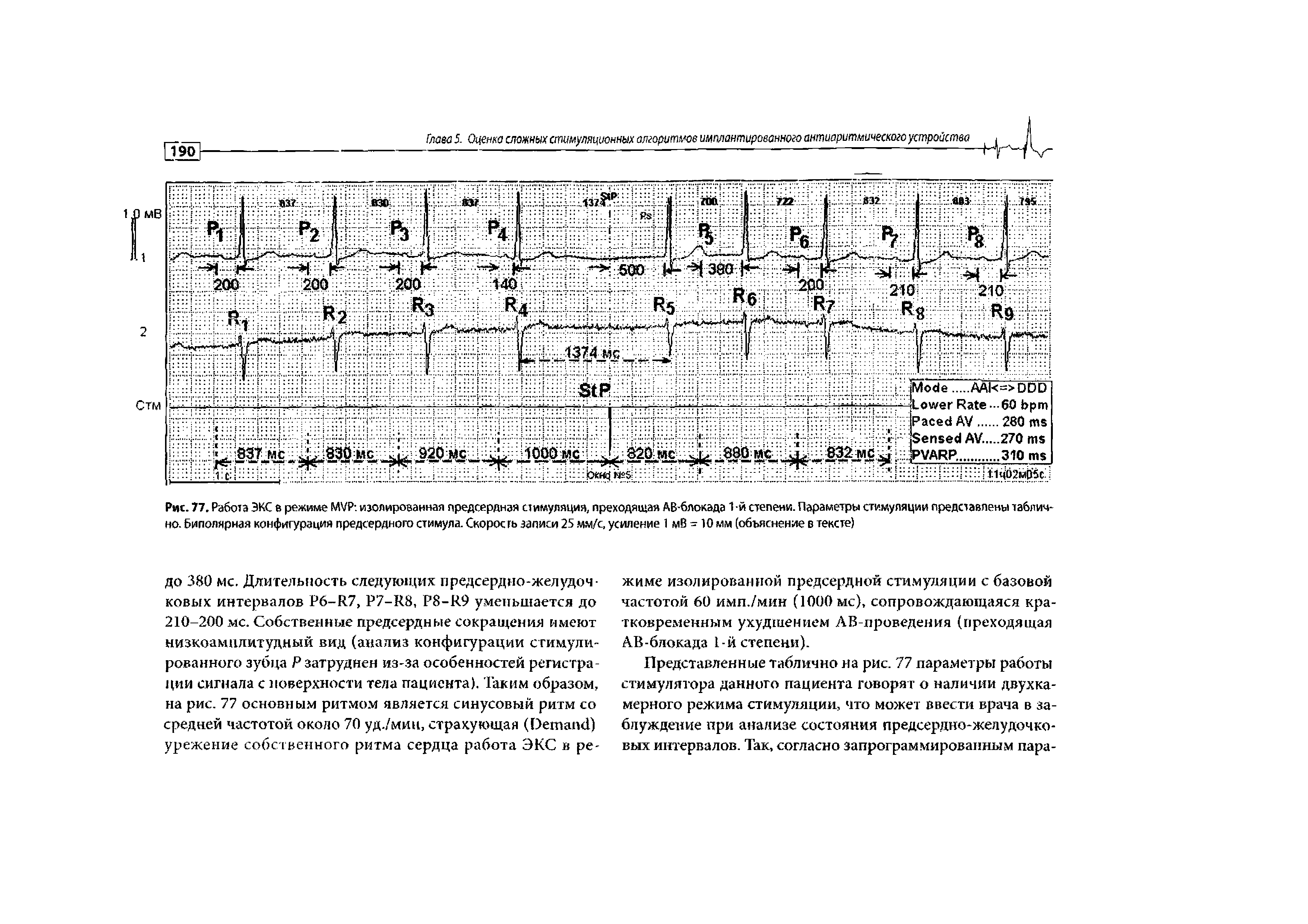 Рис. 77. Работа ЭКС в режиме МУР изолированная предсердная стимуляция, преходящая АВ-6локада 1 -й степени. Параметры стимуляции представлены таблично. Биполярная конфигурация предсердного стимула. Скорость записи 25 мм/с, усиление 1 мВ -10 мм (объяснение в тексте)...