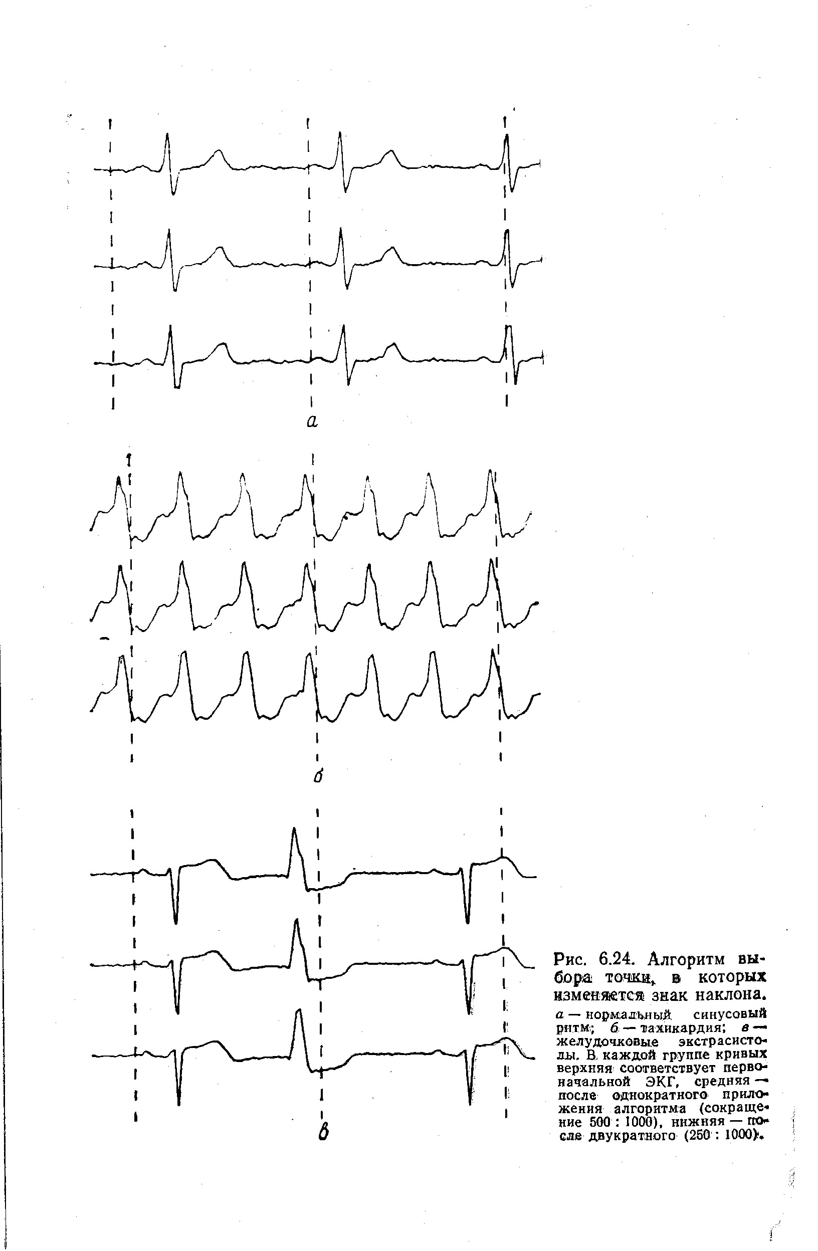 Рис. 6.24. Алгоритм выбора точки, в которых изменяется знак наклона. а — нормальный, синусовый ритм б — тахикардия в — желудочковые экстрасистолы. В. каждой группе кривых верхняя соответствует первоначальной ЭКГ, средняя — после однократного приложения алгоритма (сокращение 500 1000), нижняя — после двукратного (250 1000. ...