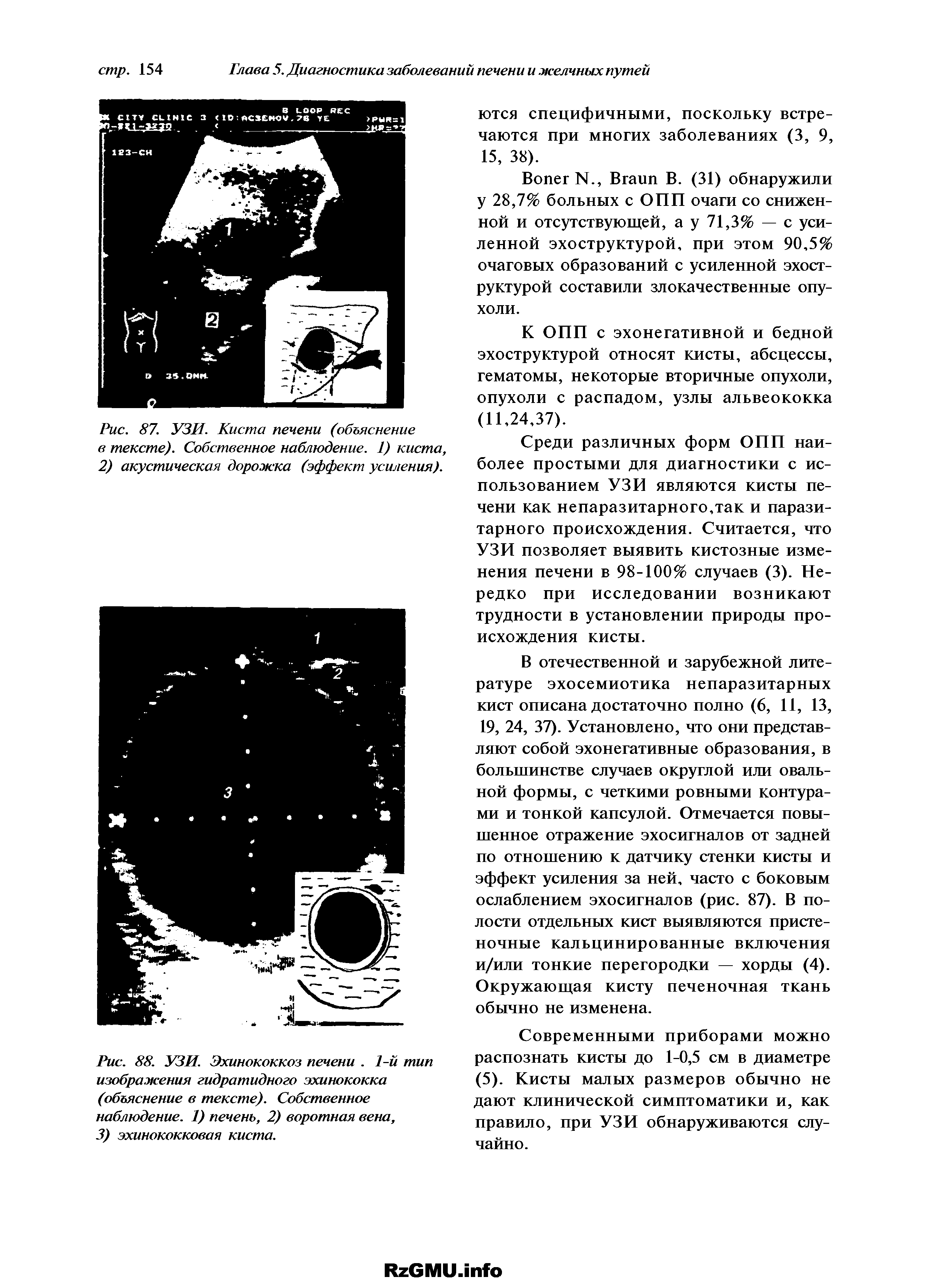 Рис. 88. УЗИ. Эхинококкоз печени. 1-й тип изображения гидратидного эхинококка (объяснение в тексте). Собственное наблюдение. 1) печень, 2) воротная вена, 3) эхинококковая киста.