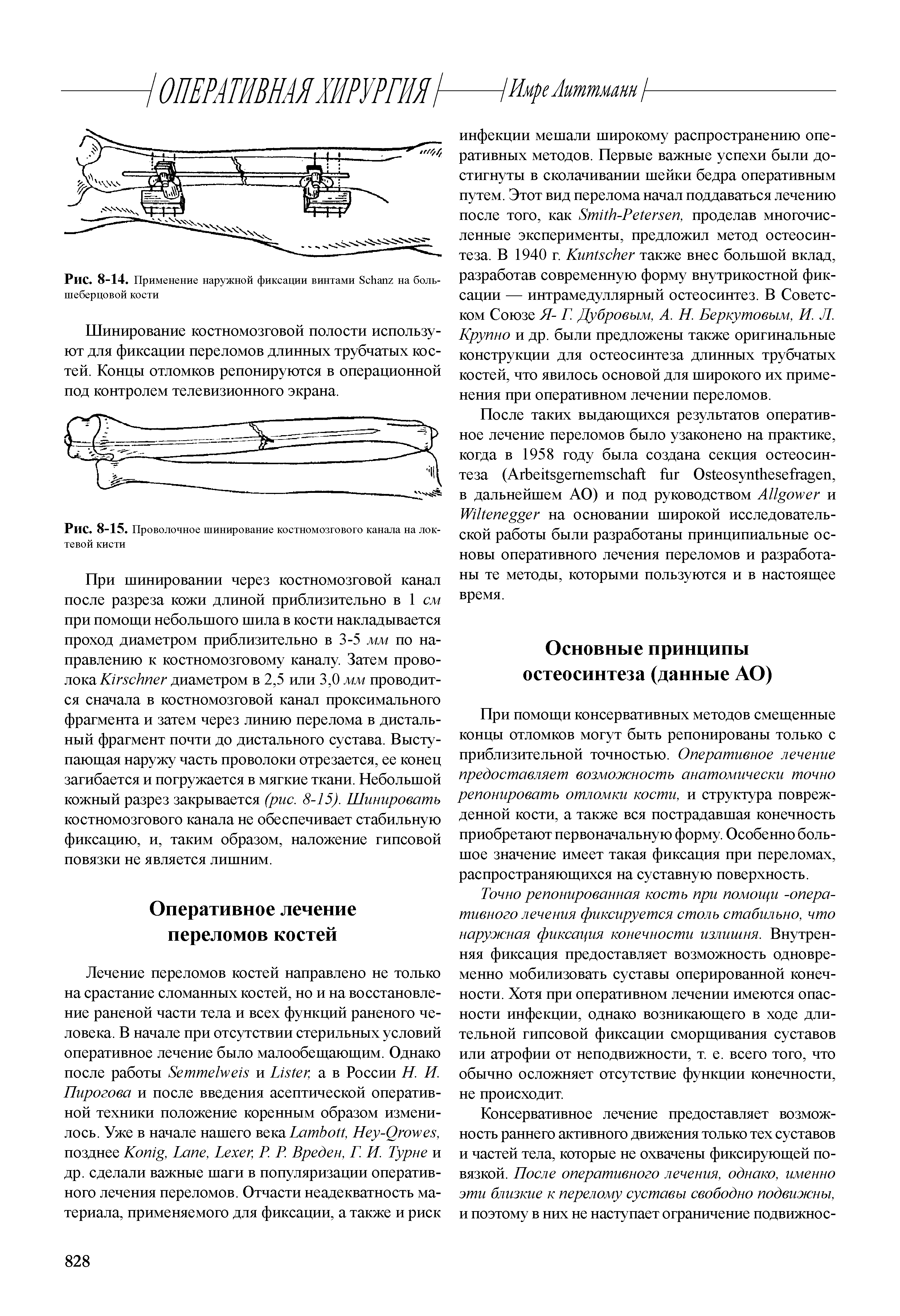 Рис. 8-15. Проволочное шинирование костномозгового канала на локтевой кисти...