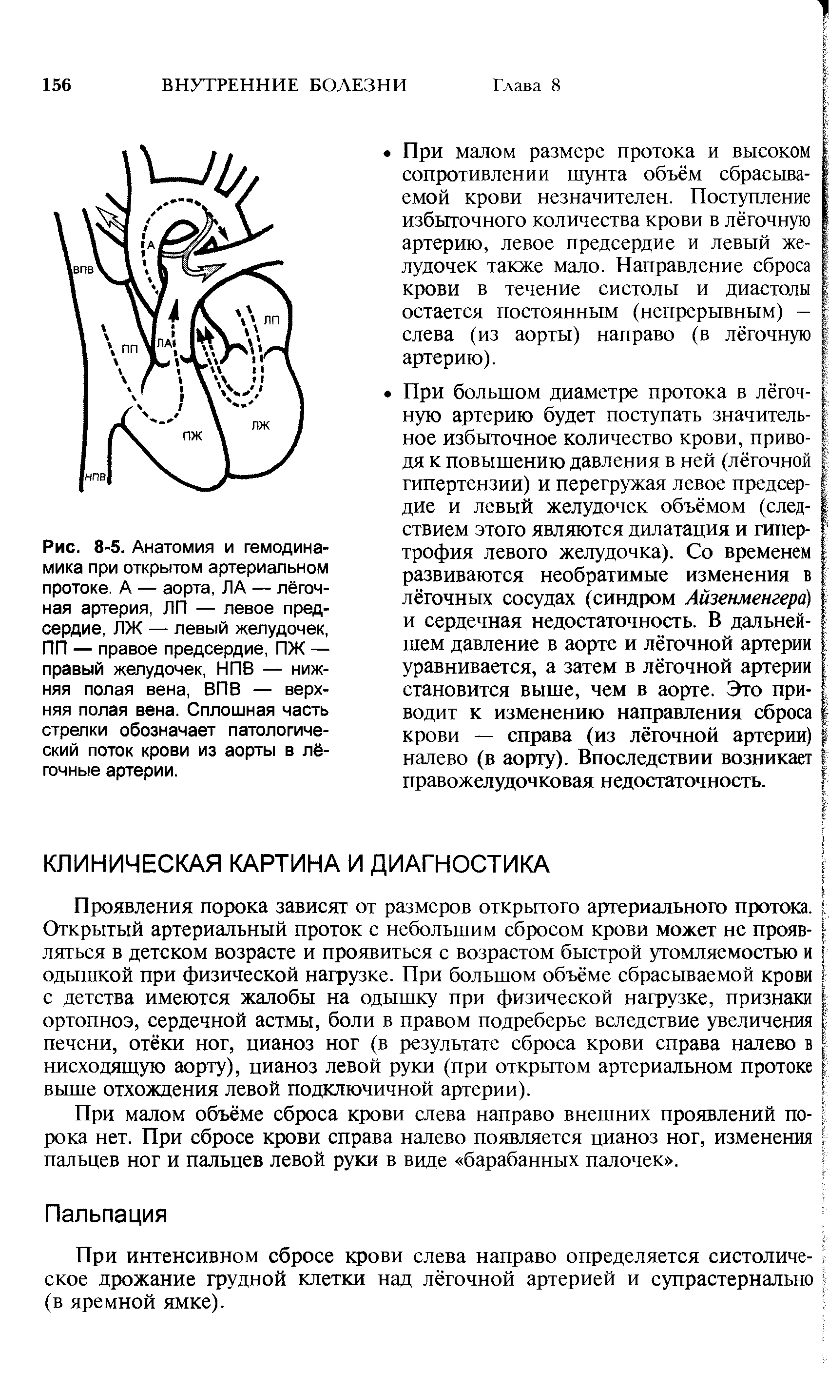 Рис. 8-5. Анатомия и гемодинамика при открытом артериальном протоке. А — аорта, ЛА — лёгочная артерия, ЛП — левое предсердие, ЛЖ — левый желудочек, ПП — правое предсердие, ПЖ — правый желудочек, НПВ — нижняя полая вена, ВПВ — верхняя полая вена. Сплошная часть стрелки обозначает патологический поток крови из аорты в лёгочные артерии.