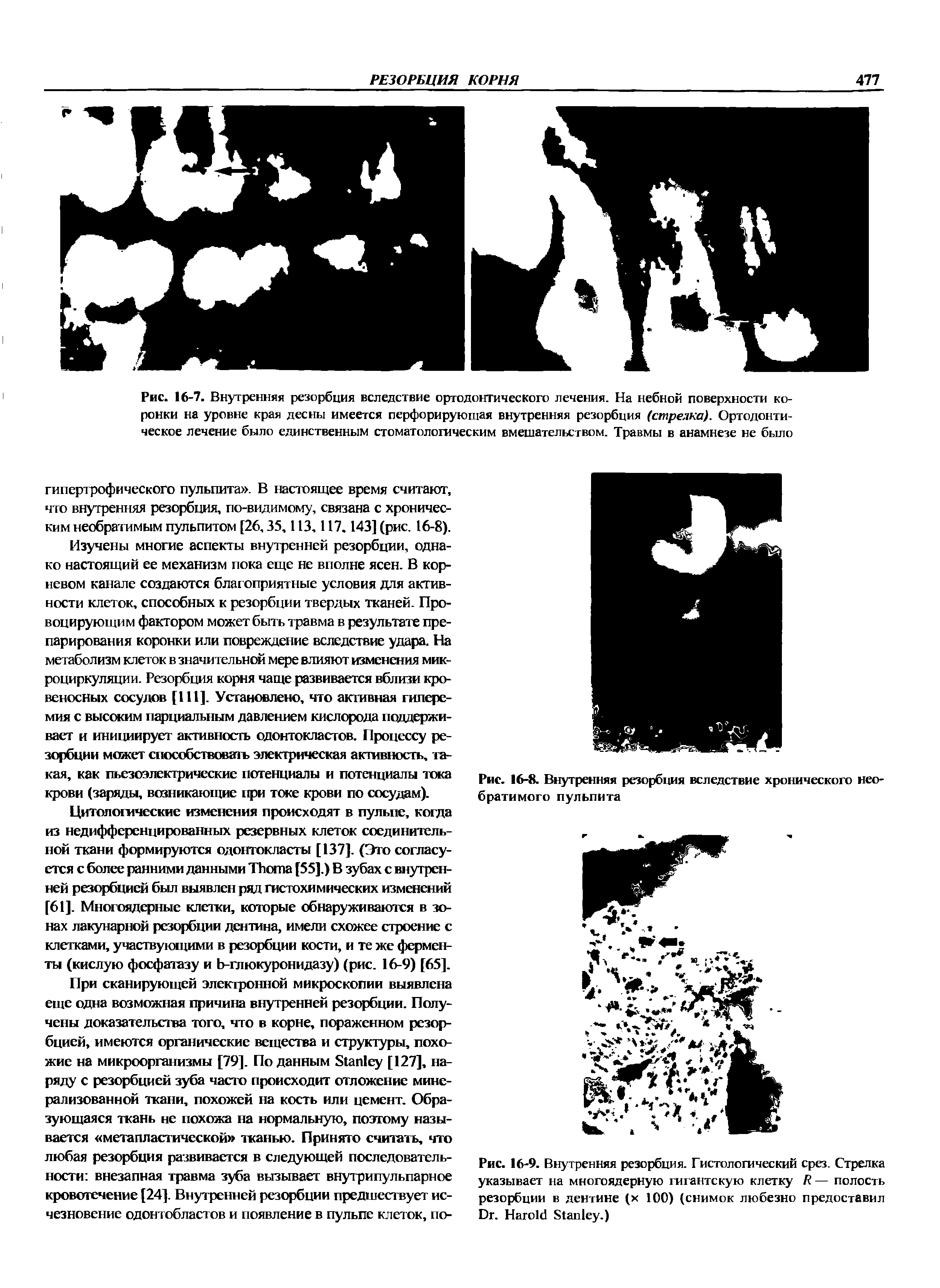 Рис. 16-9. Внутренняя резорбция. Гистологический срез. Стрелка указывает на многоядерную гигантскую клетку R — полость резорбции в дентине (х 100) (снимок любезно предоставил D . H S .)...