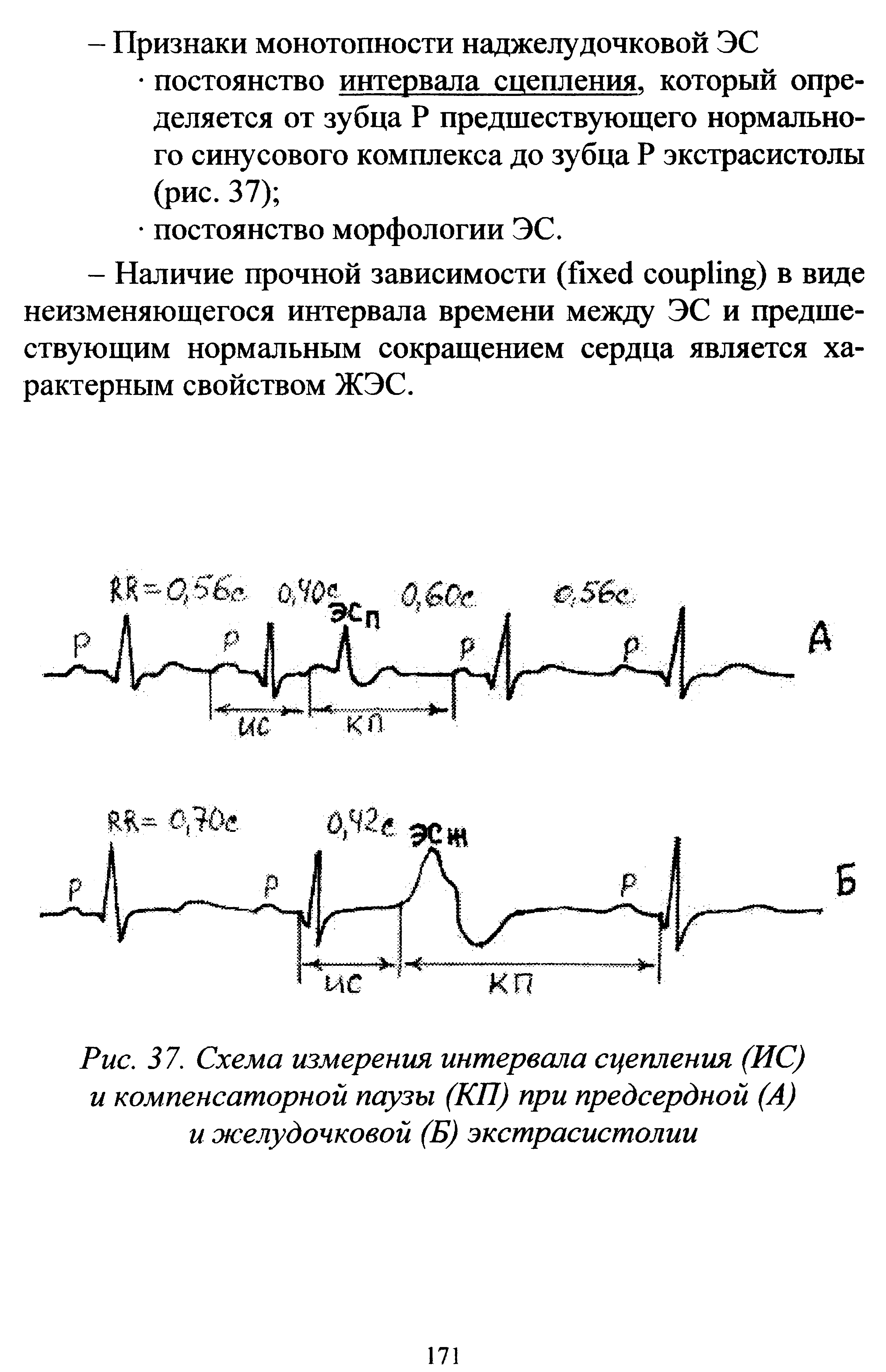 Рис. 37. Схема измерения интервала сцепления (ИС) и компенсаторной паузы (КП) при предсердной (А) и желудочковой (Б) экстрасистолии...