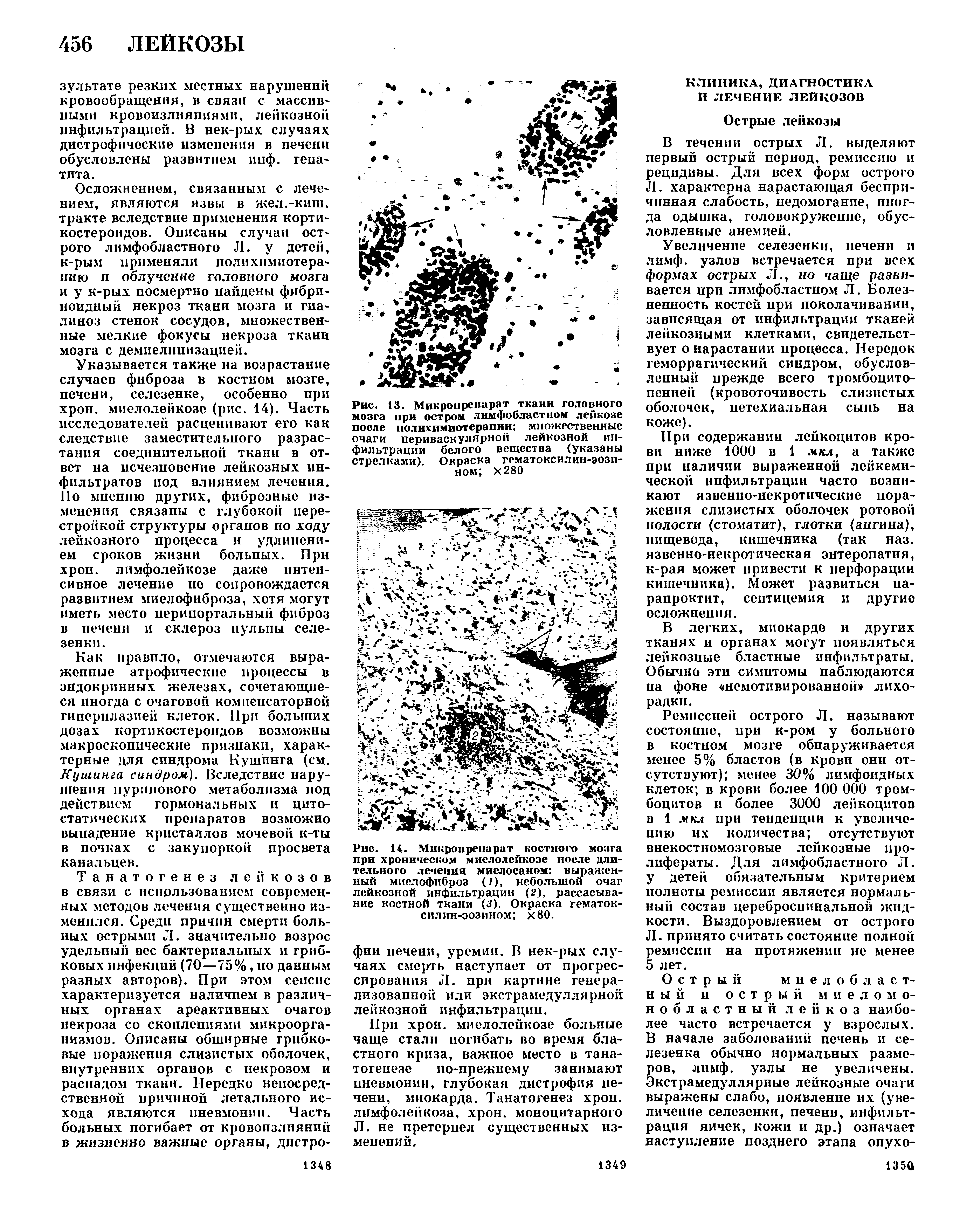 Рис. 13. Микропрепарат ткани головного мозга при остром лимфобластном лейкозе после полихимиотерапии множественные очаги периваскулярной лейкозной инфильтрации белого вещества (указаны стрелками). Окраска гематоксилин-эози-ном Х280...