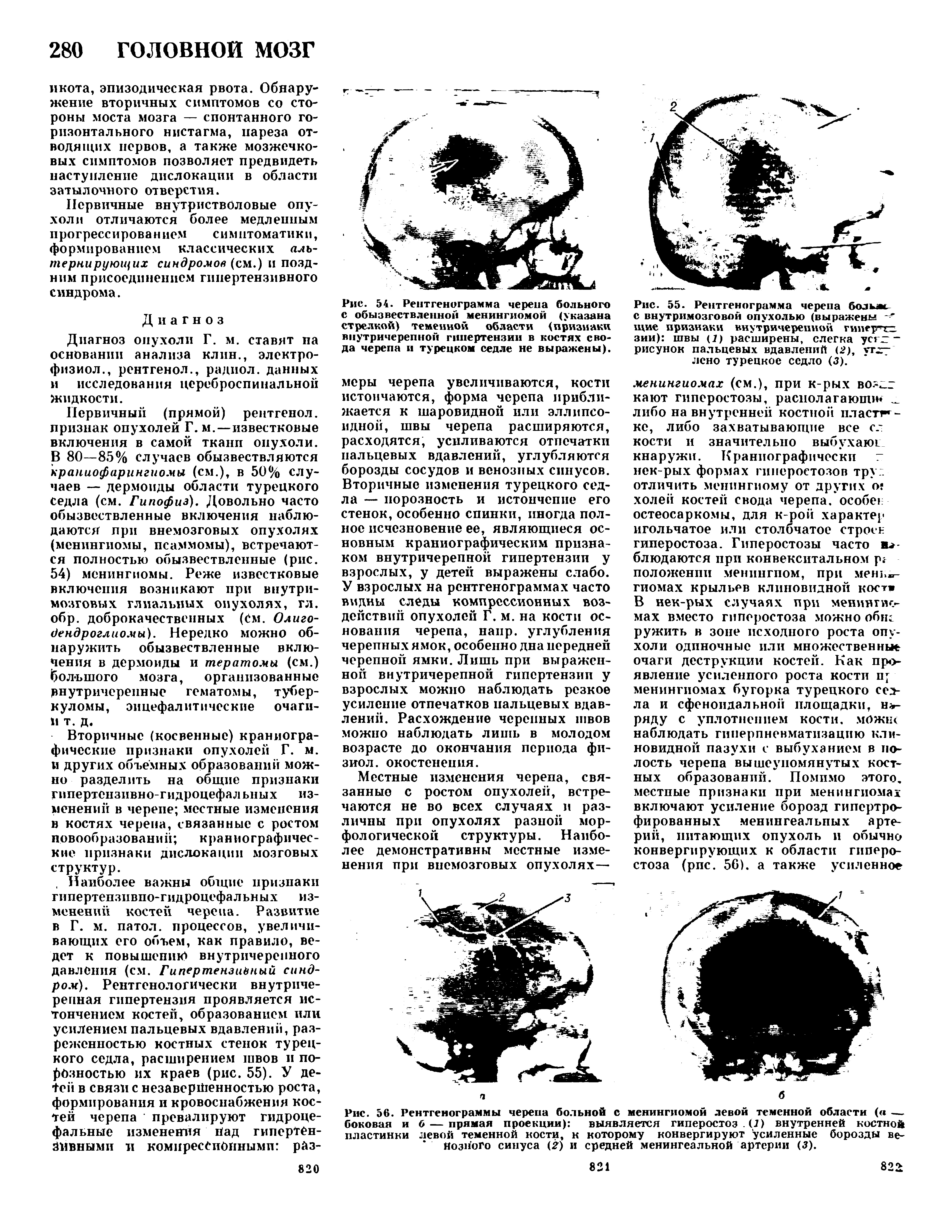 Рис. 56. Рентгенограммы черепа больной с менингиомой левой теменной области (а — боковая и 6 — прямая проекции) выявляется гиперостоз. (7) внутренней костной пластинки левой теменной кости, к которому конвергируют усиленные борозды венозного синуса ( ) и средней менингеальной артерии (5).