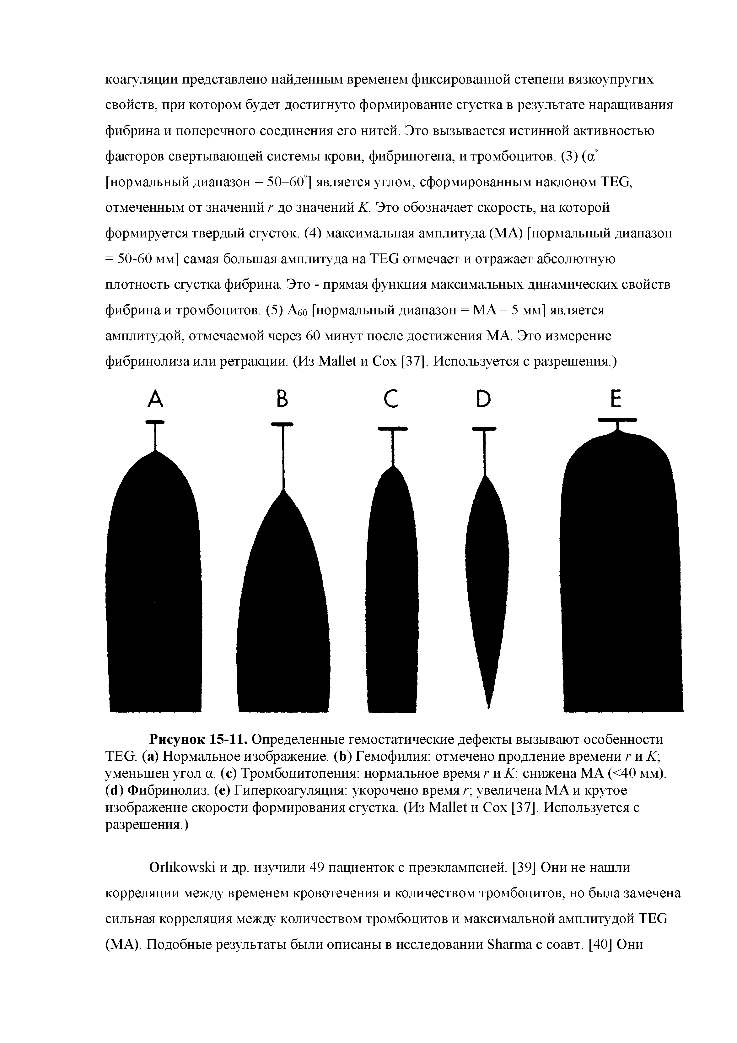 Рисунок 15-11. Определенные гемостатические дефекты вызывают особенности TEG. (а) Нормальное изображение. (Ь) Гемофилия отмечено продление времени ги А уменьшен угол а. (с) Тромбоцитопения нормальное время г и К снижена МА (<40 мм), ( ) Фибринолиз, (е) Гиперкоагуляция укорочено время г увеличена МА и крутое изображение скорости формирования сгустка. (Из M и Сох [37]. Используется с разрешения.)...