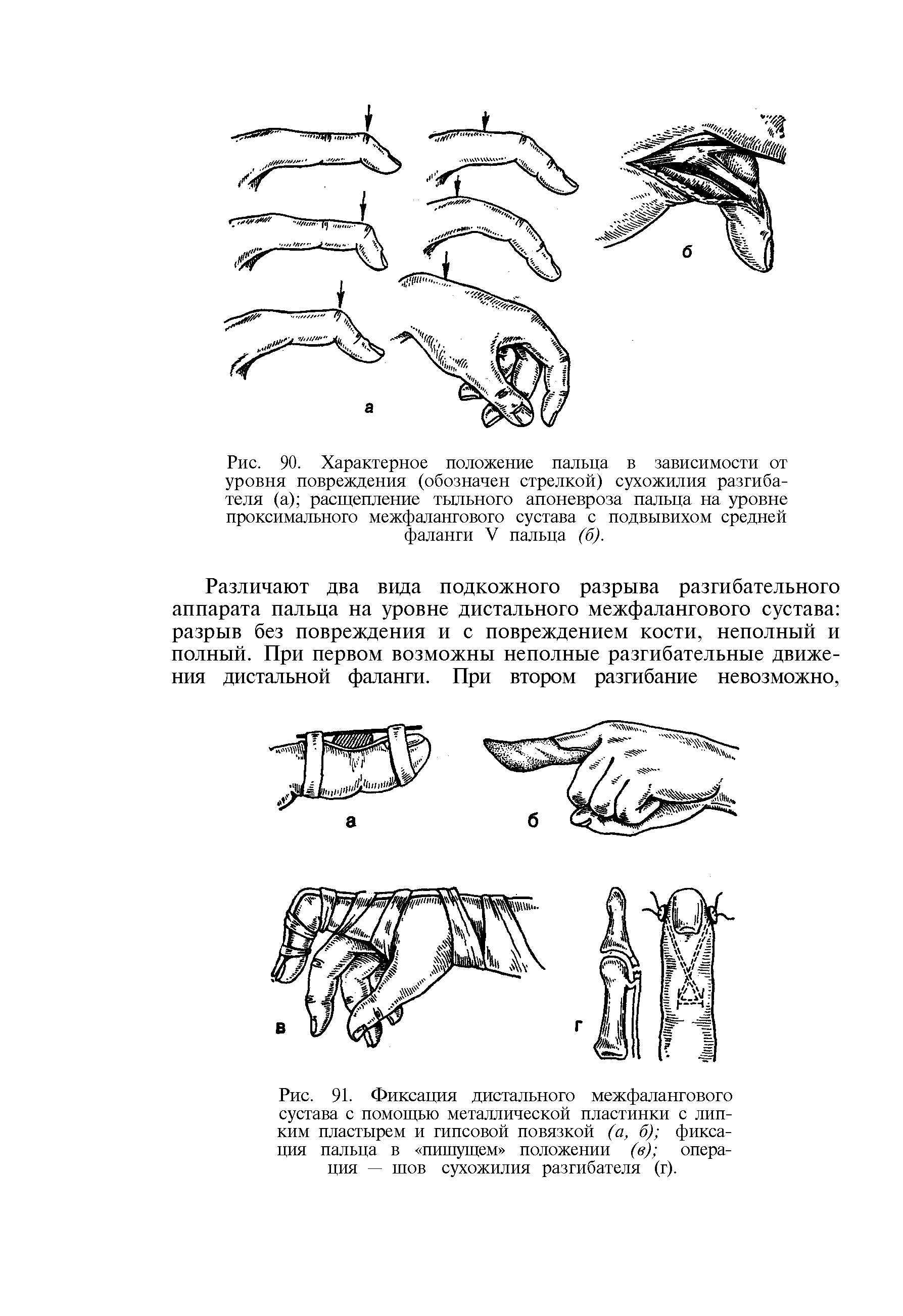 Рис. 91. Фиксация дистального межфалангового сустава с помощью металлической пластинки с липким пластырем и гипсовой повязкой (а, б) фиксация пальца в пишущем положении (в) операция — шов сухожилия разгибателя (г).