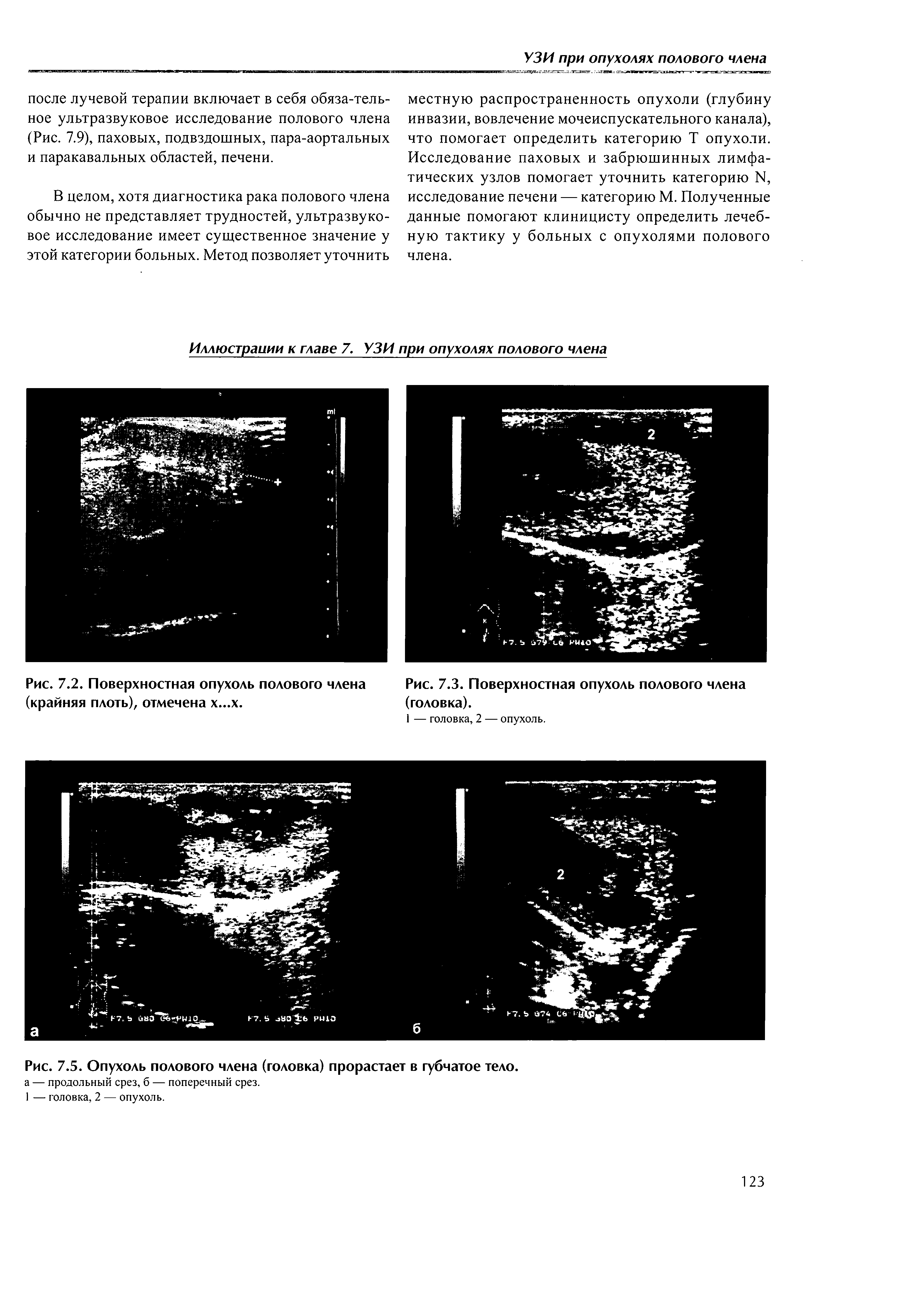 Рис. 7.2. Поверхностная опухоль полового члена (крайняя плоть), отмечена х...х.