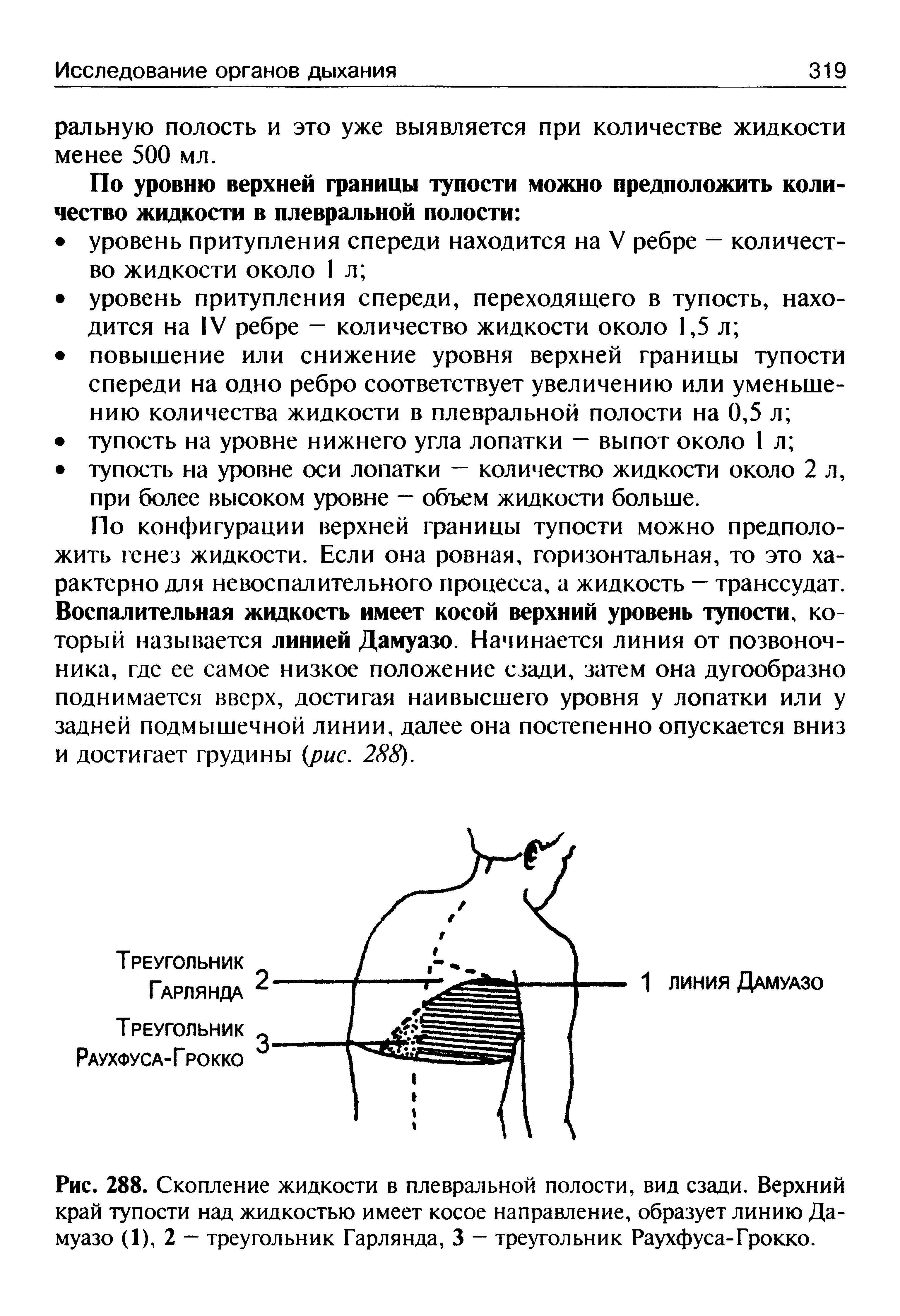 Рис. 288. Скопление жидкости в плевральной полости, вид сзади. Верхний край тупости над жидкостью имеет косое направление, образует линию Дамуазо (1), 2 — треугольник Гарлянда, 3 - треугольник Раухфуса-Грокко.