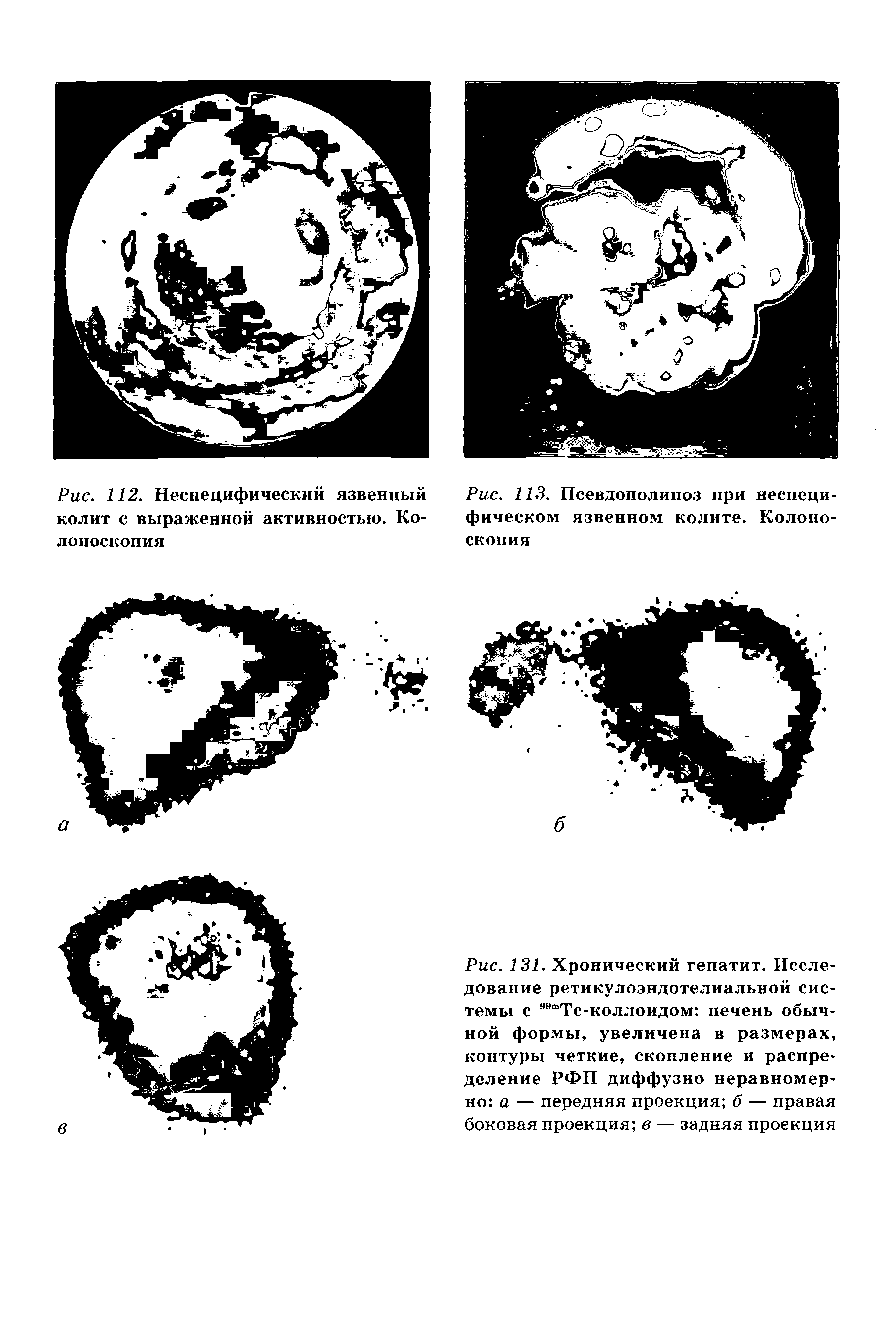 Рис. 131. Хронический гепатит. Исследование ретикулоэндотелиальной системы с "тТс-коллоидом печень обычной формы, увеличена в размерах, контуры четкие, скопление и распределение РФП диффузно неравномерно а — передняя проекция б — правая боковая проекция в — задняя проекция...