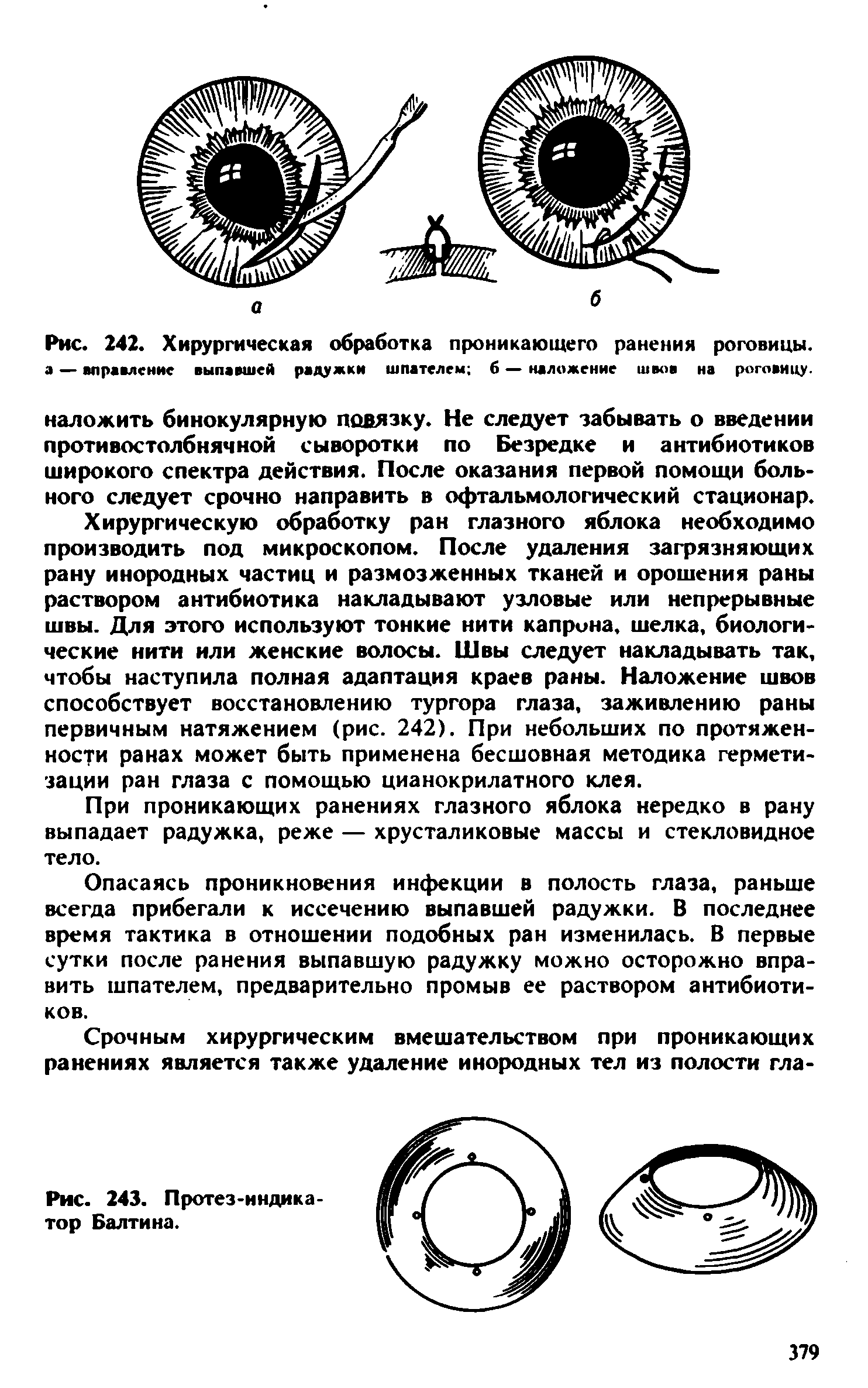 Рис. 242. Хирургическая обработка проникающего ранения роговицы, а — вправление выпавшей радужки шпателем б — наложение швоа на роговицу, наложить бинокулярную повязку. Не следует забывать о введении противостолбнячной сыворотки по Безредке и антибиотиков широкого спектра действия. После оказания первой помощи больного следует срочно направить в офтальмологический стационар.