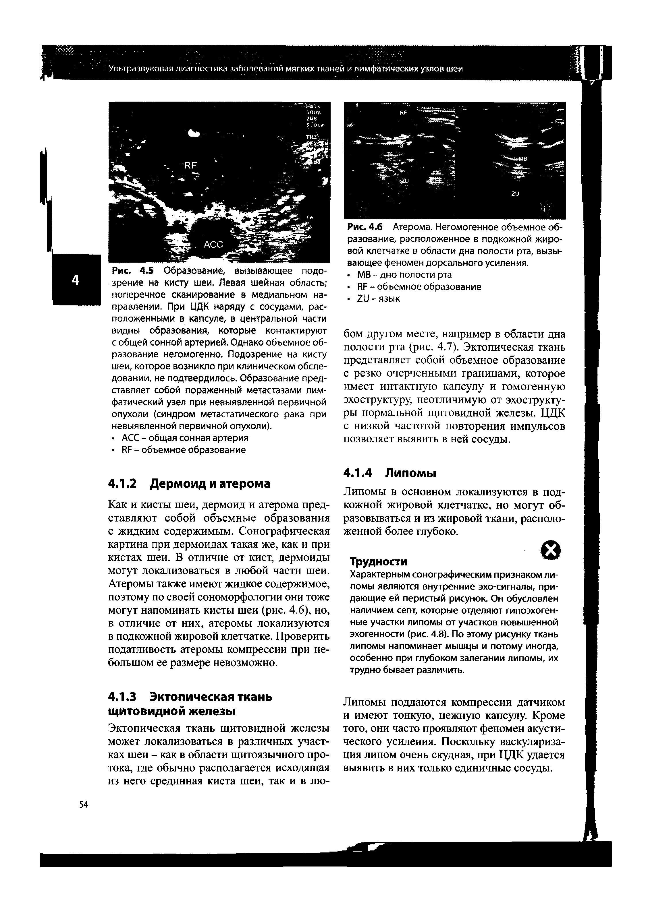 Рис. 4.6 Атерома. Негомогенное объемное образование, расположенное в подкожной жировой клетчатке в области дна полости рта, вызывающее феномен дорсального усиления.