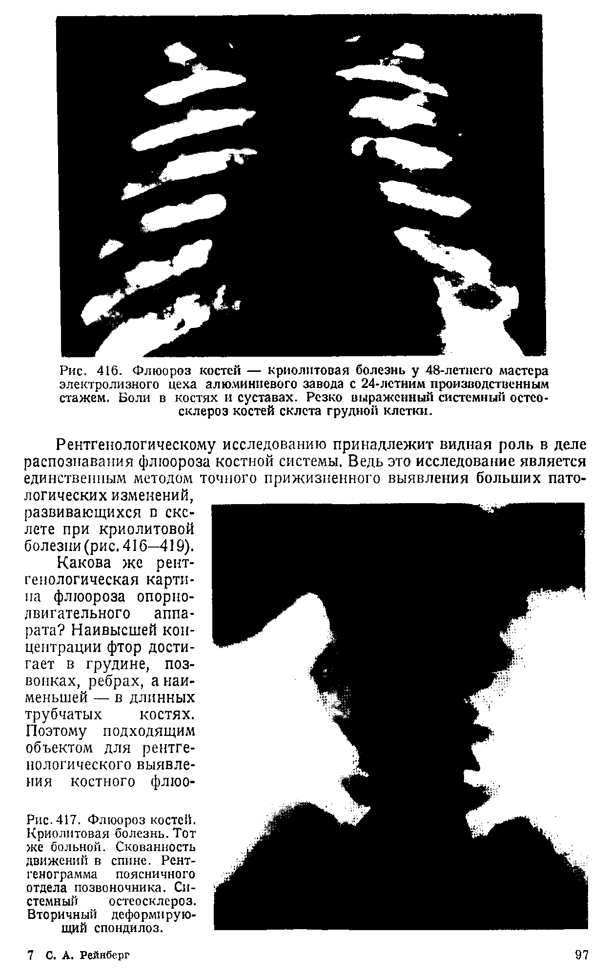 Рис.417. Флюороз костей. Криолитовая болезнь. Тот же больной. Скованность движений в спине. Рентгенограмма поясничного отдела позвоночника. Системный остеосклероз. Вторичный деформирующий спондилоз.