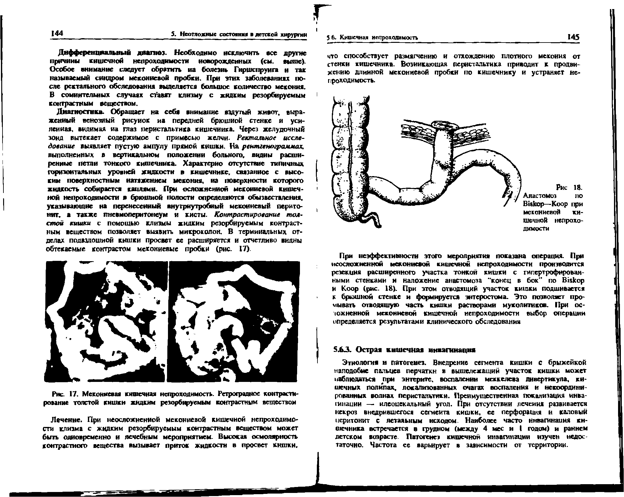 Рис. 17. Меконкевая кишечная непроходимость. Ретроградное контрастирование толстой кишки жидким резорбтфуемым контрастным веществом...